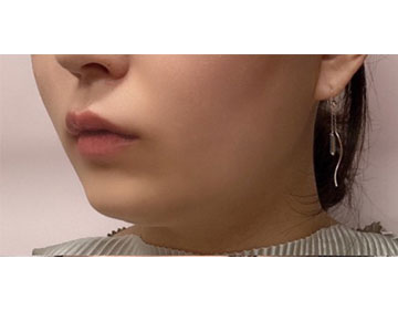 颏下脂肪抽吸 打鼾 睡眠呼吸暂停