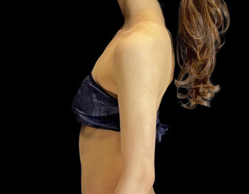 liposuction hair shedding female