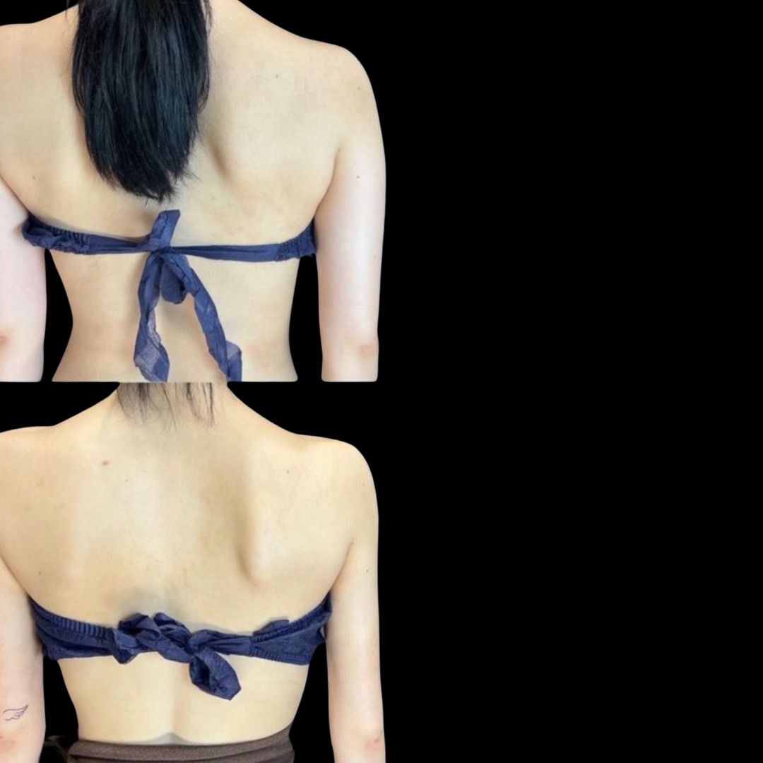 nâng ngực mỡ tự thân tỷ lệ sống cơ chế