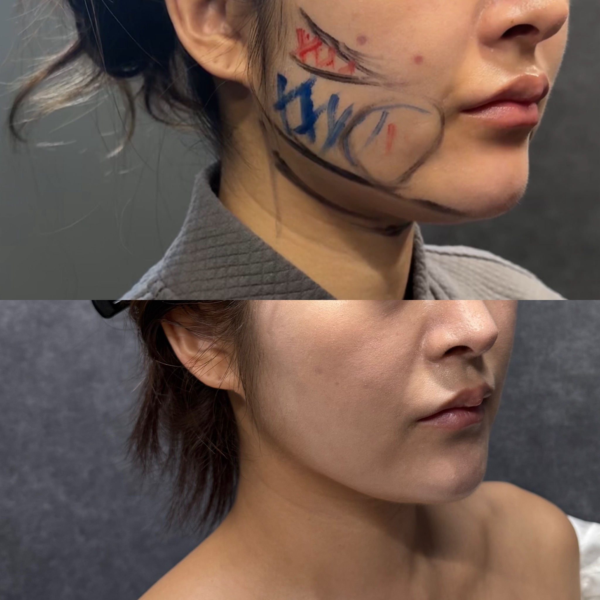 脂肪抽吸 血栓预防 深静脉血栓 DVT 弹力袜 安全对策