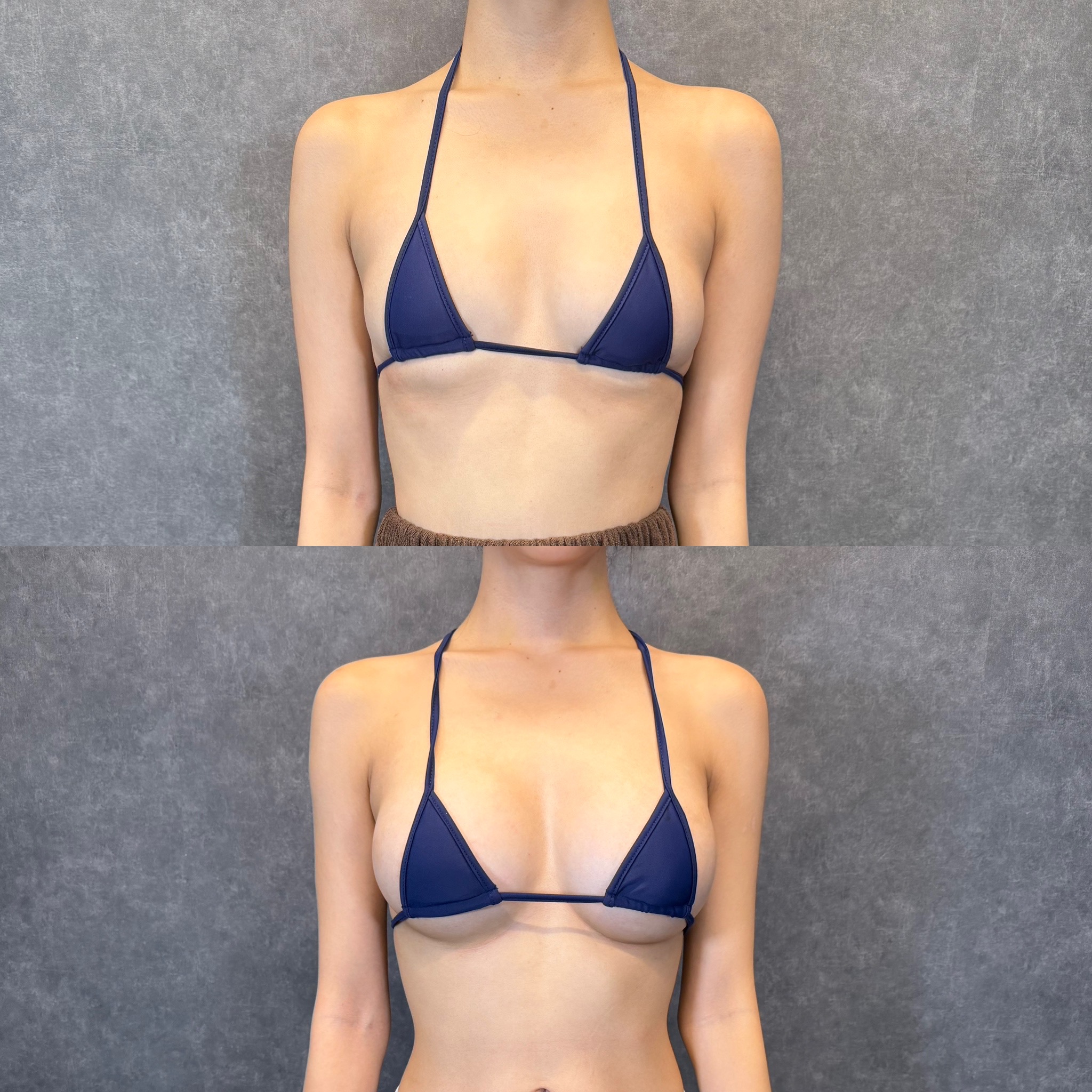 silicone breast implant thin patient rippling
