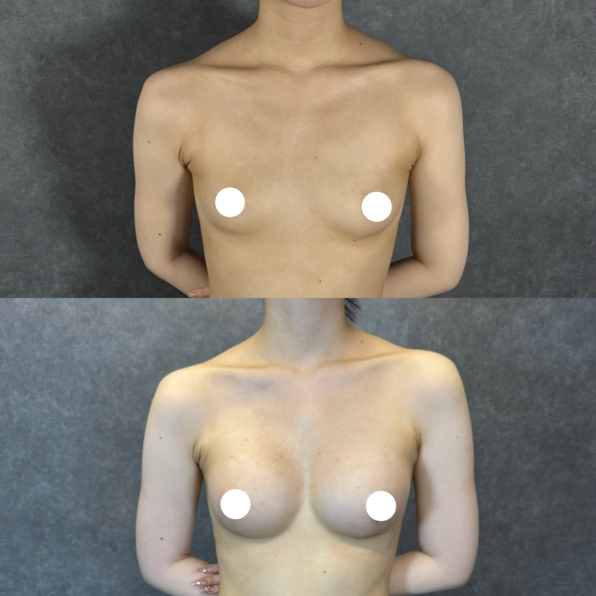 hút mỡ BMI tỷ lệ mỡ chỉ định