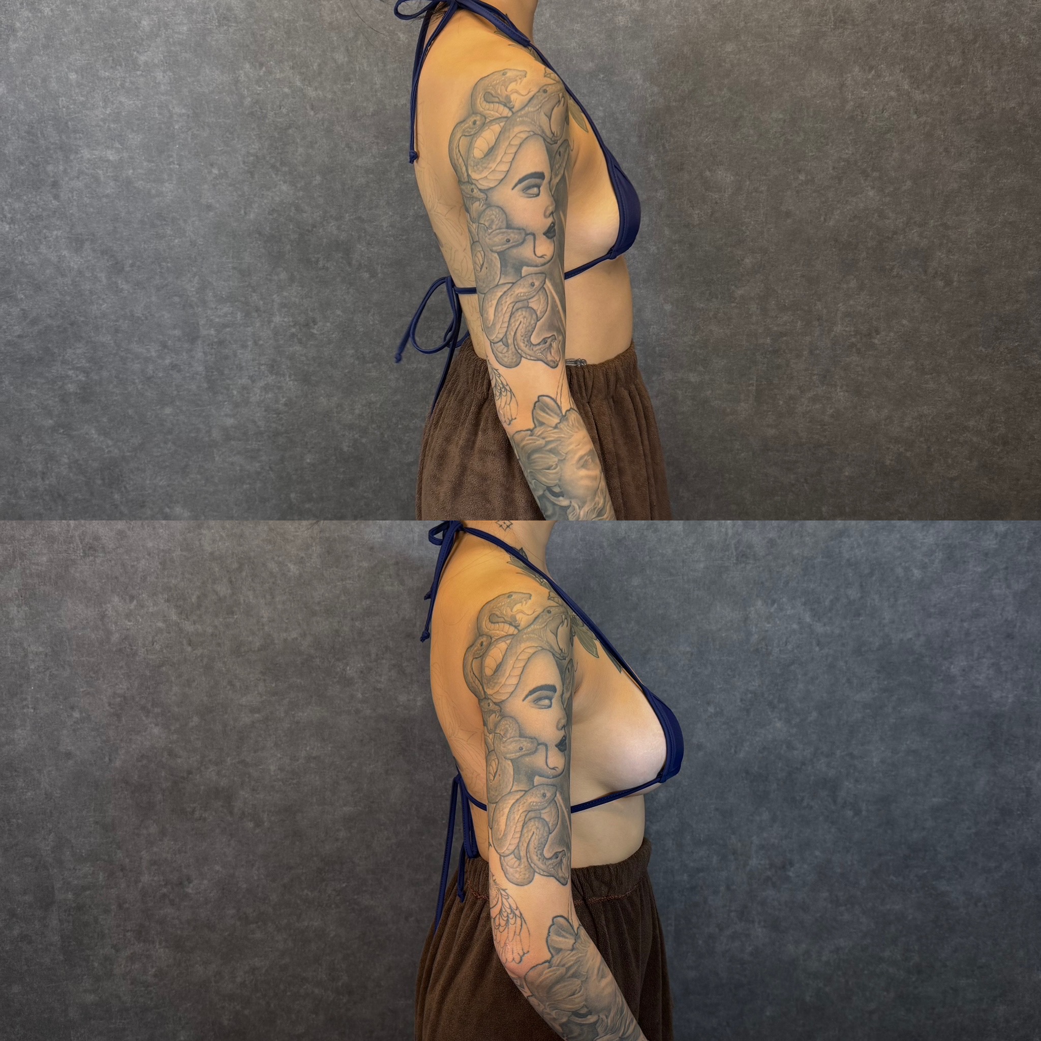 fat grafting breast augmentation survival mechanism