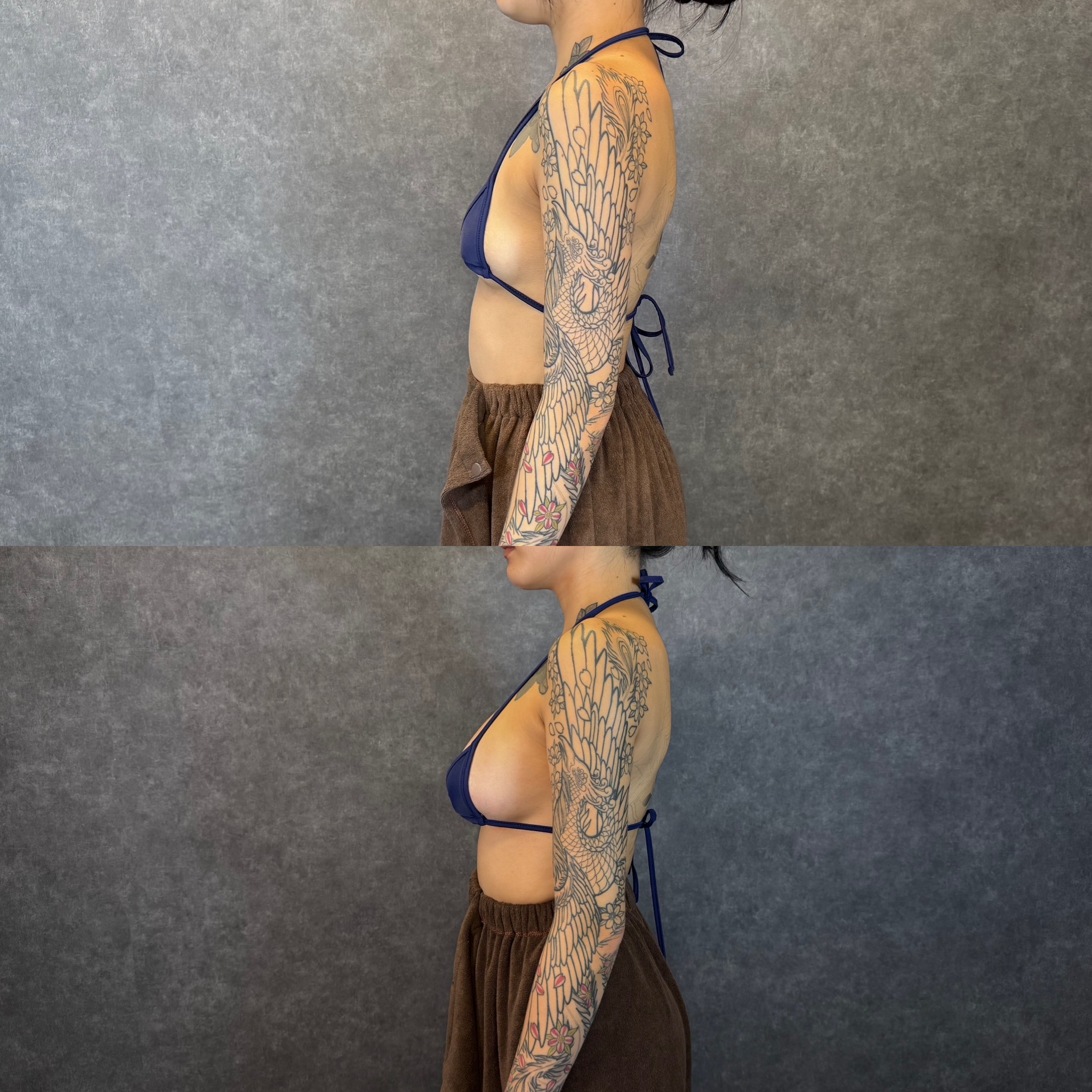 liposuction revision skin tethering adhesion dent