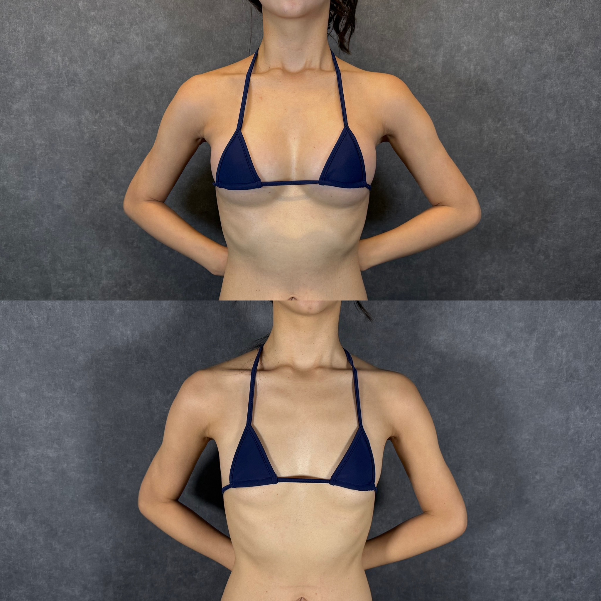 weight fluctuation liposuction stretched skin rebound