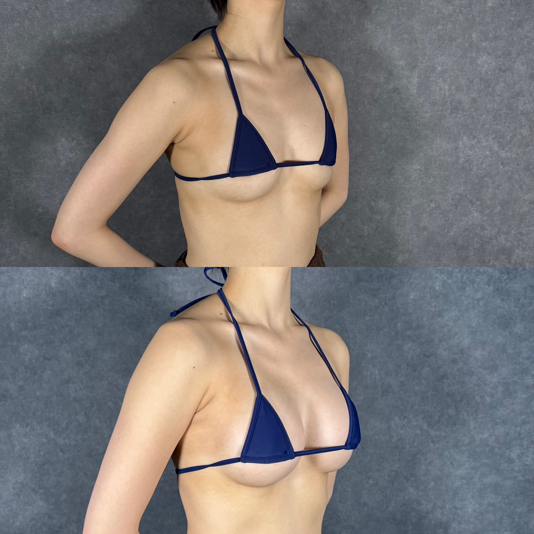 fat grafting breast nodule calcification mammography