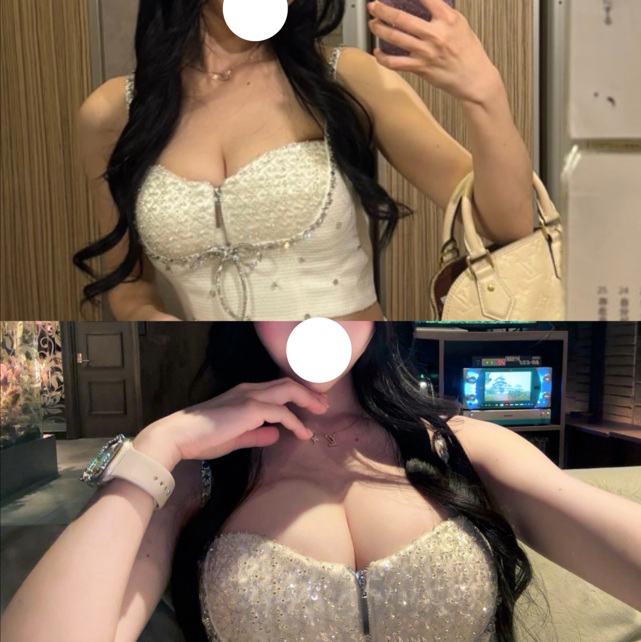 upper arm liposuction shoulder width fascia line design