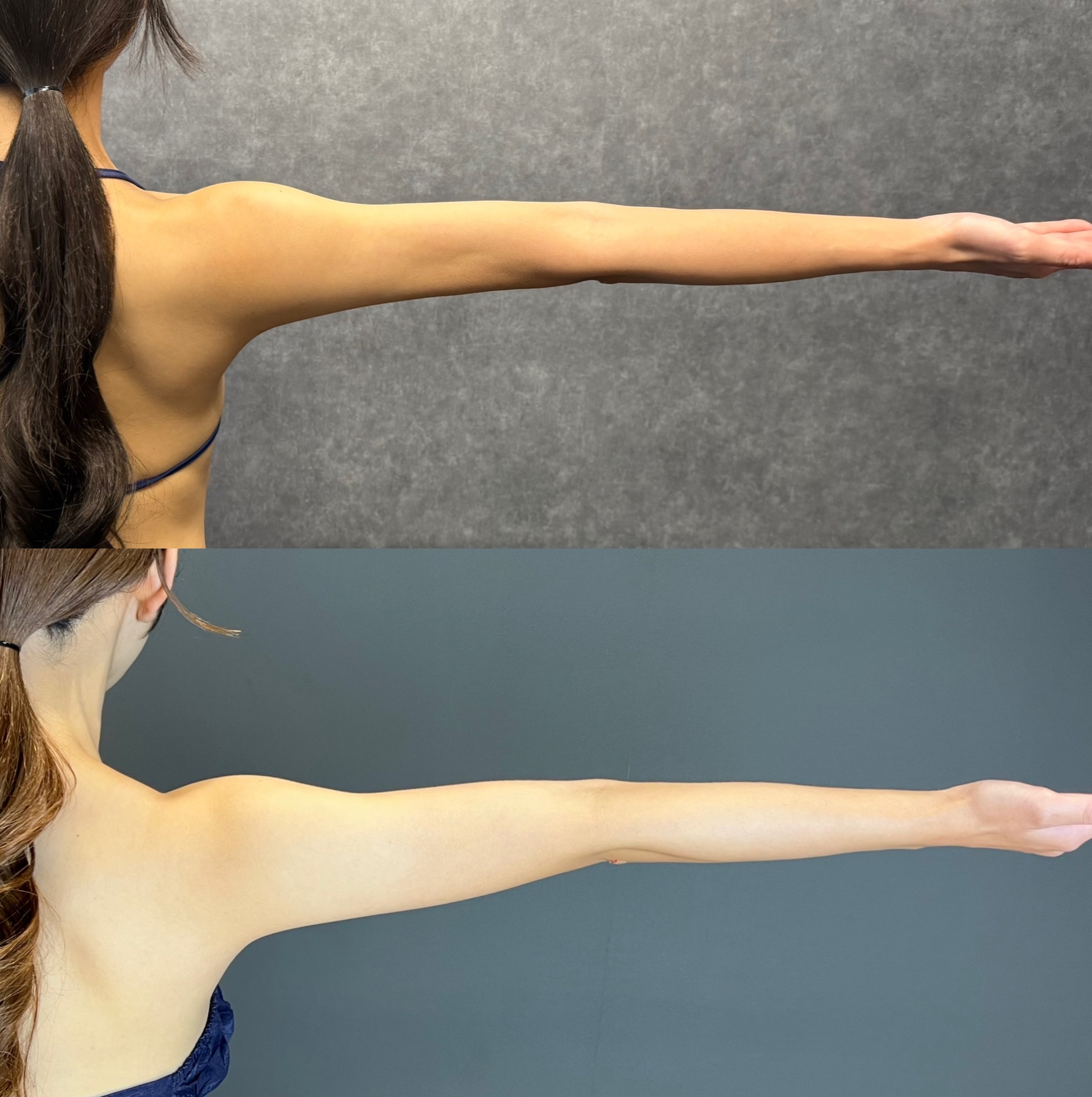 lipedema lipoedema liposuction lymphedema