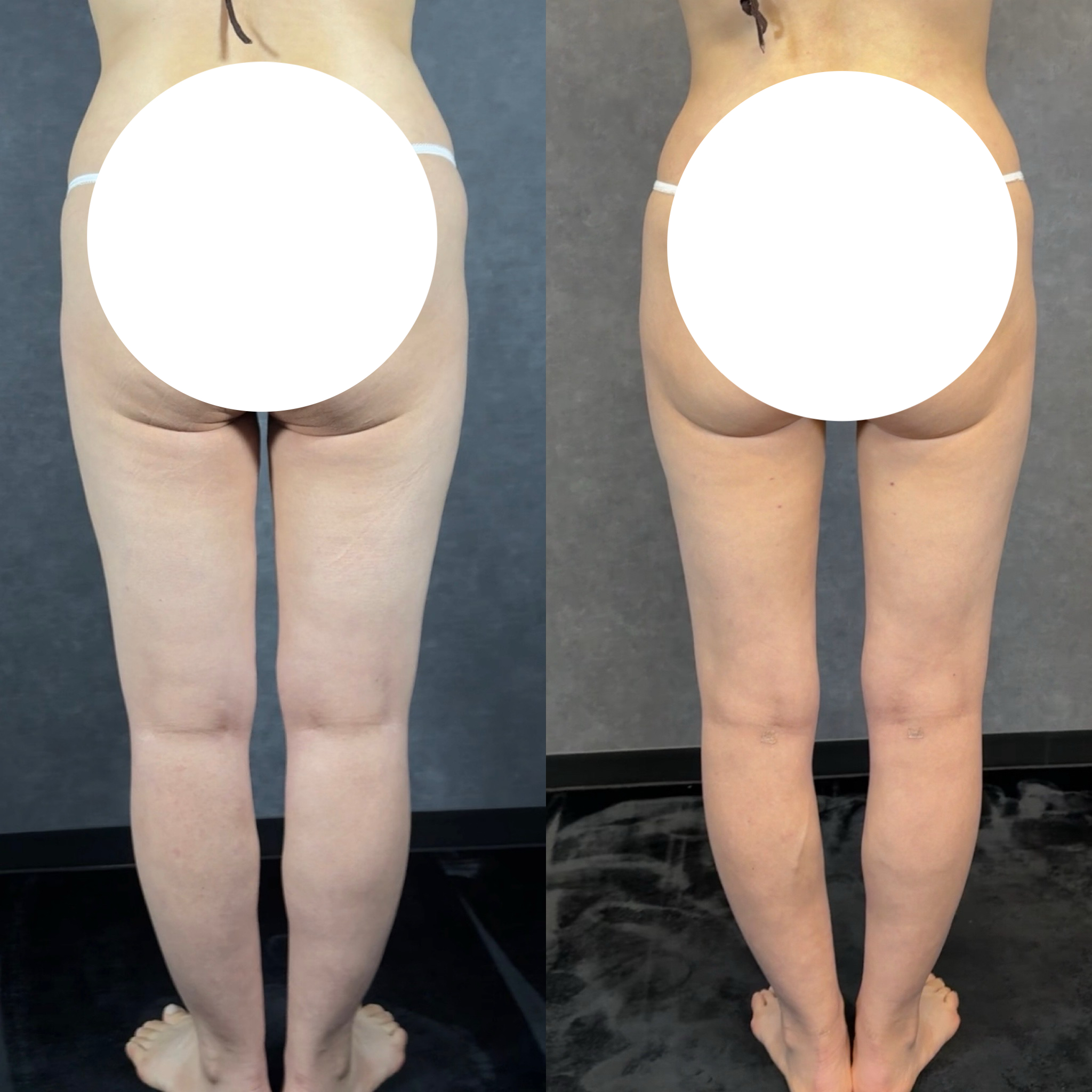 fat grafting volume retention rate