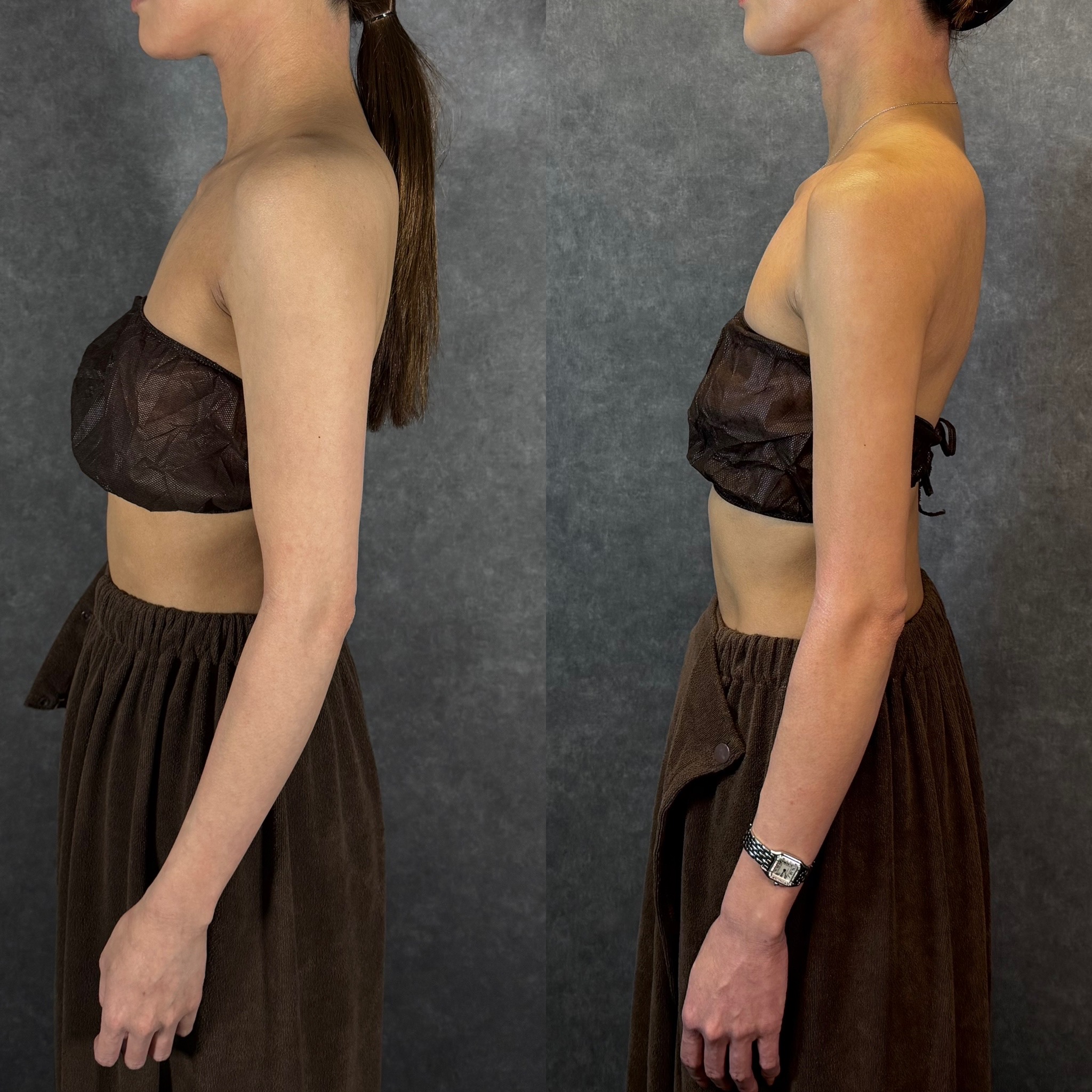 submental liposuction nerve anatomy safety