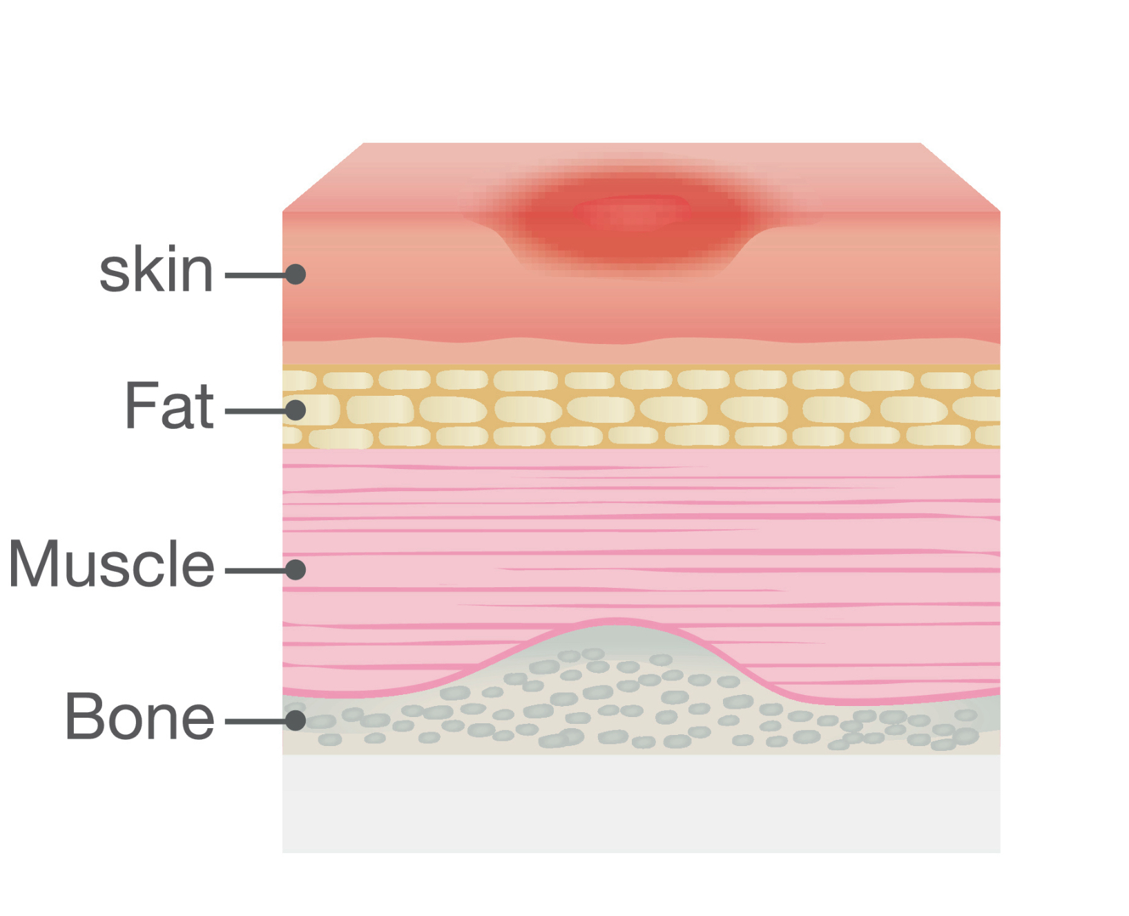 liposuction thin skin dermis