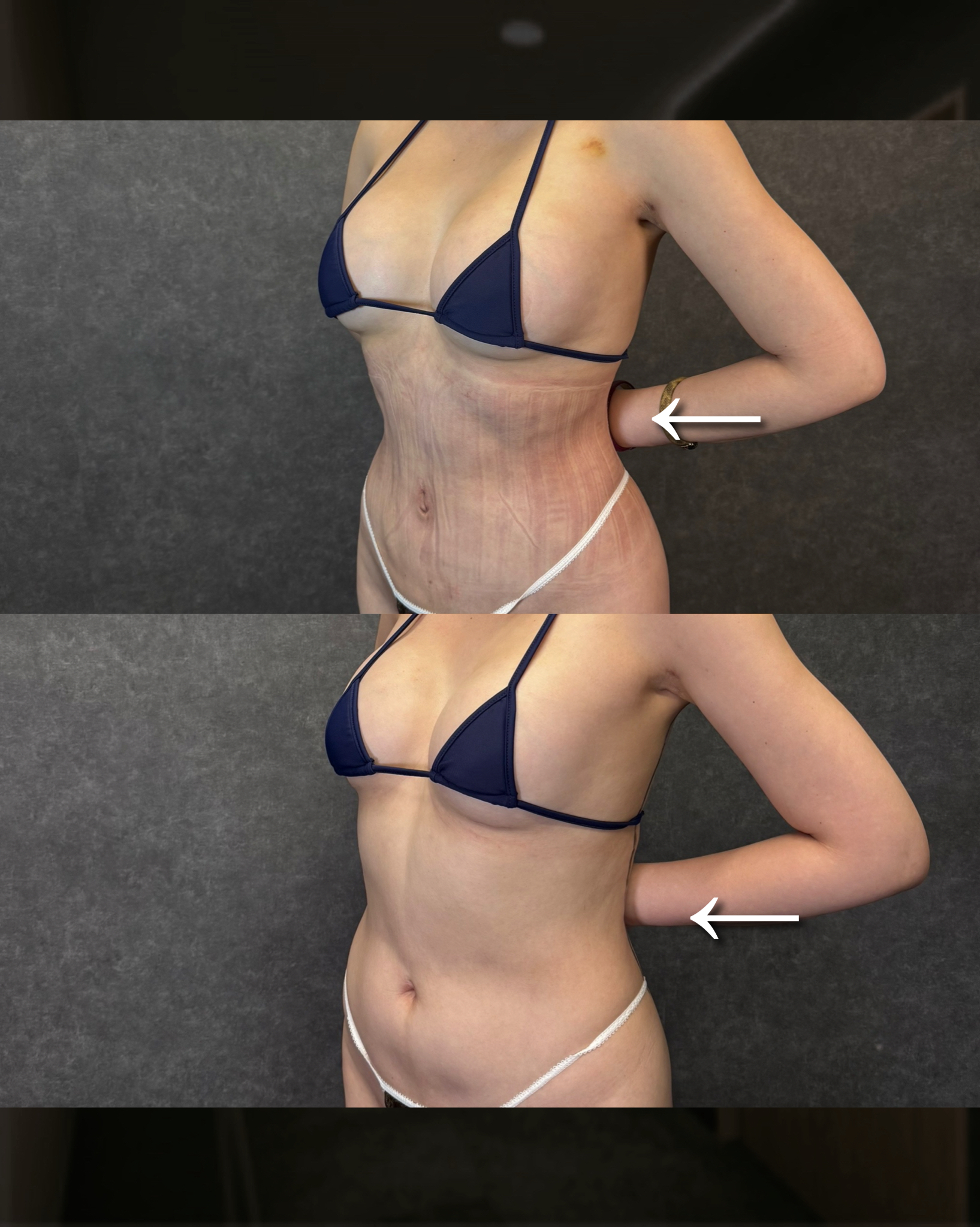 liposuction coffee preop restriction fat graft survival