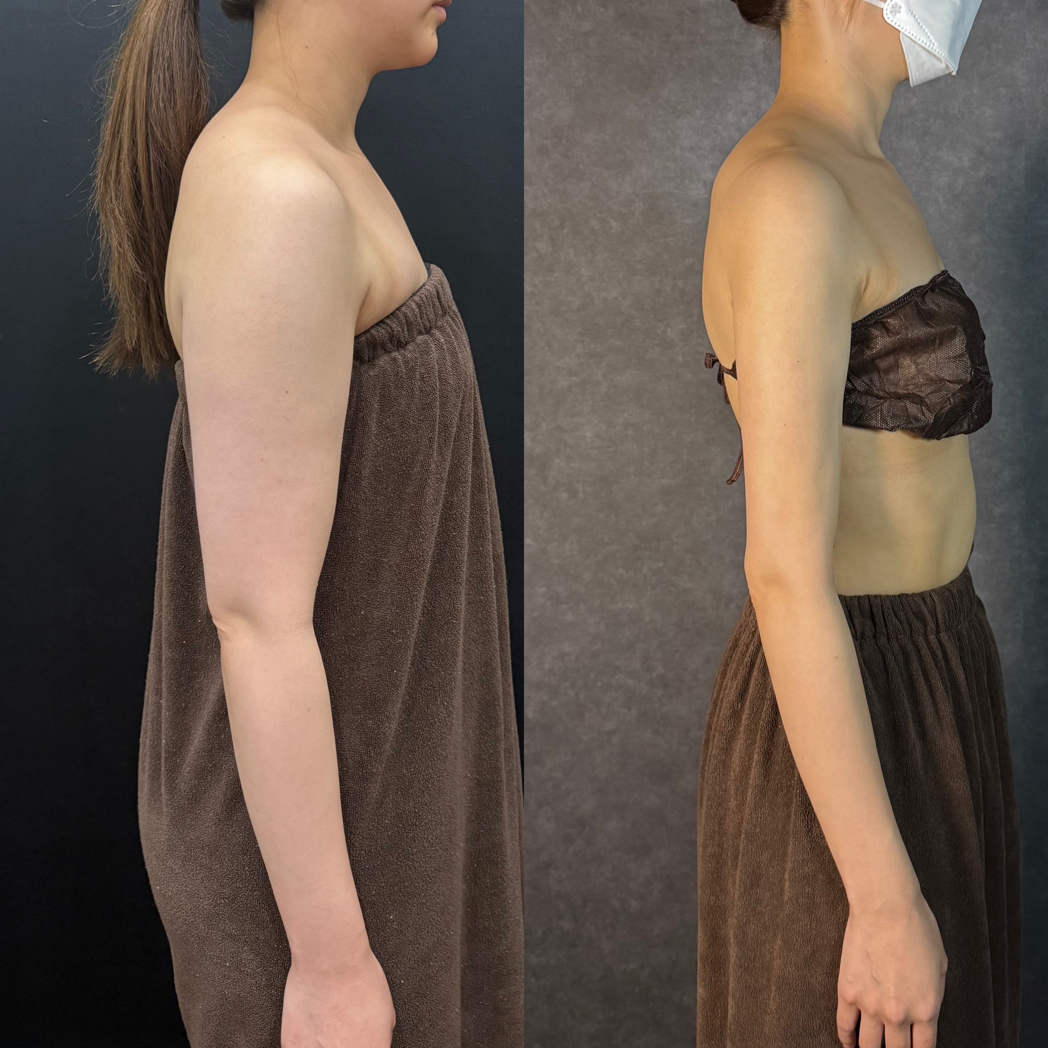 breast augmentation silicone implant