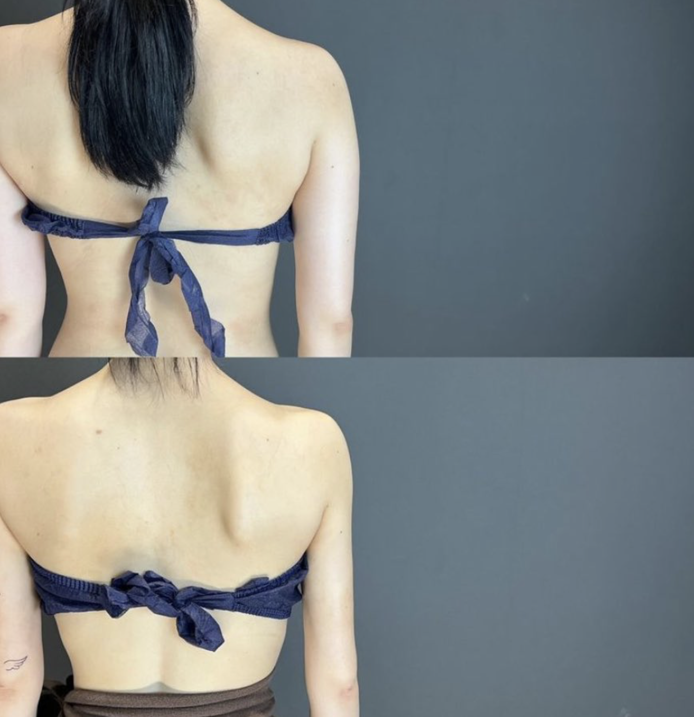 liposuction car driving safety