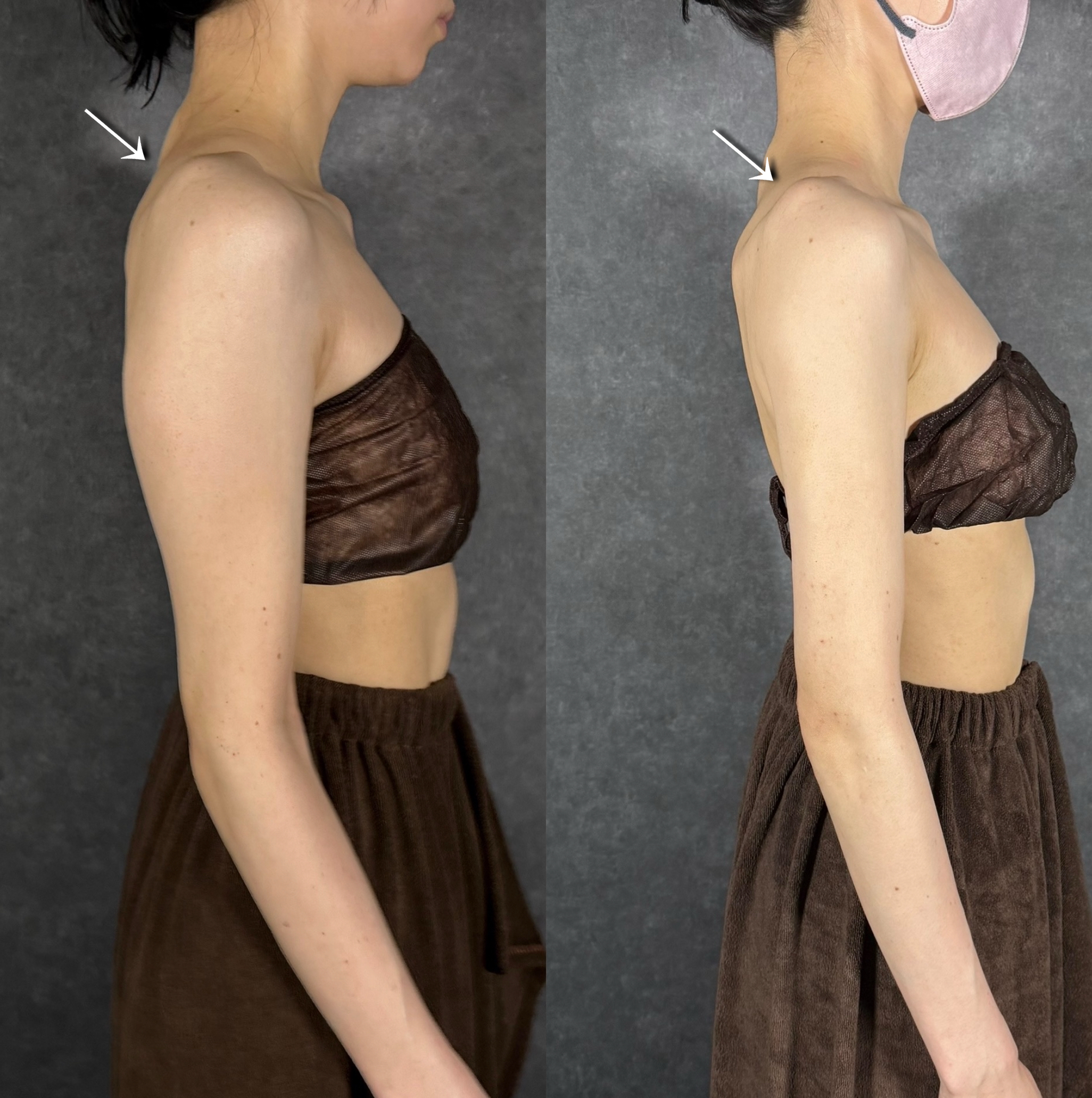 liposuction recovery skin healing