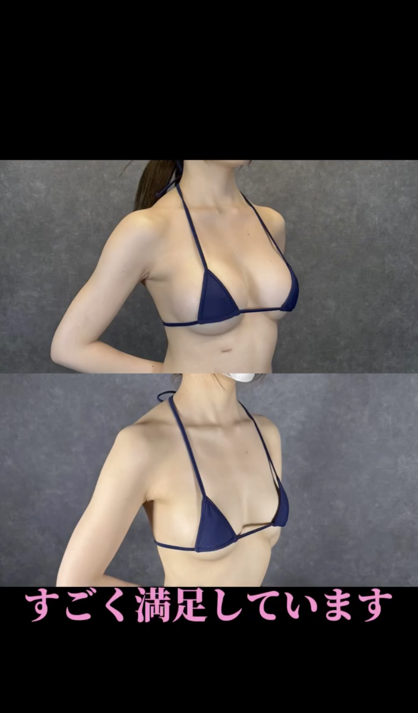 hút mỡ bằng tia nước WAL