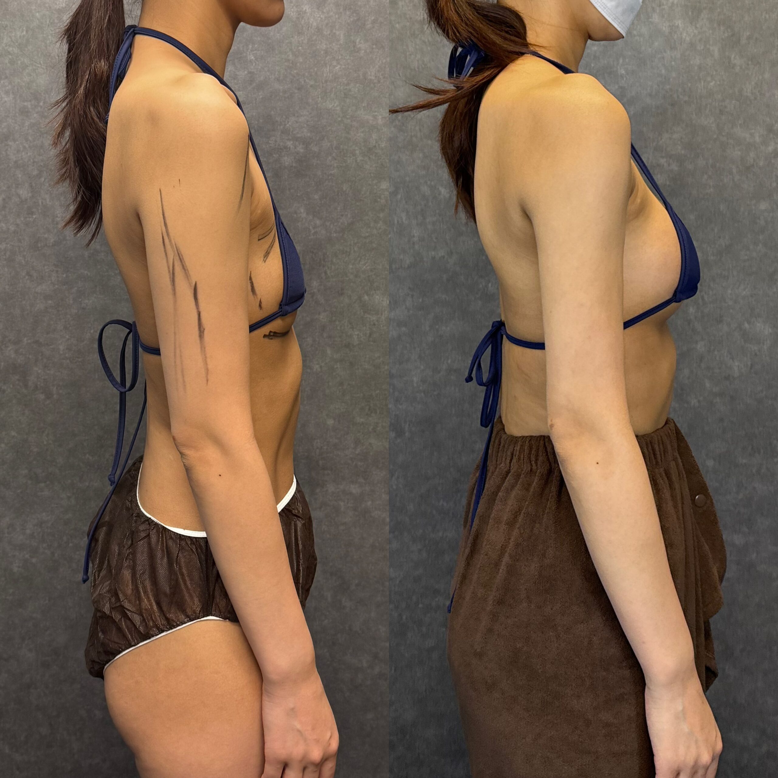 laser hair removal skin