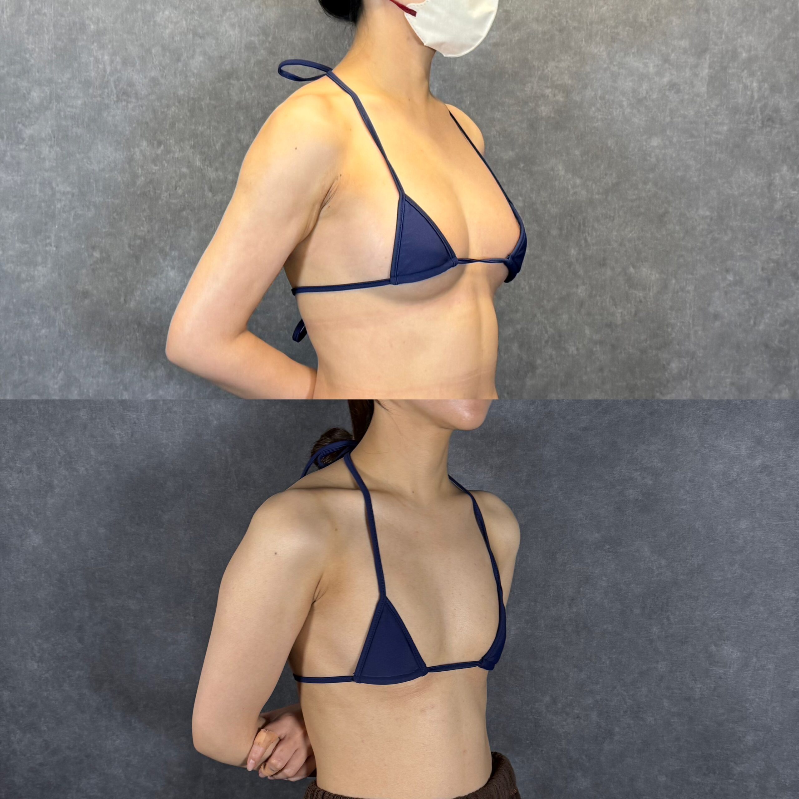 fat grafting breast augmentation injection depth
