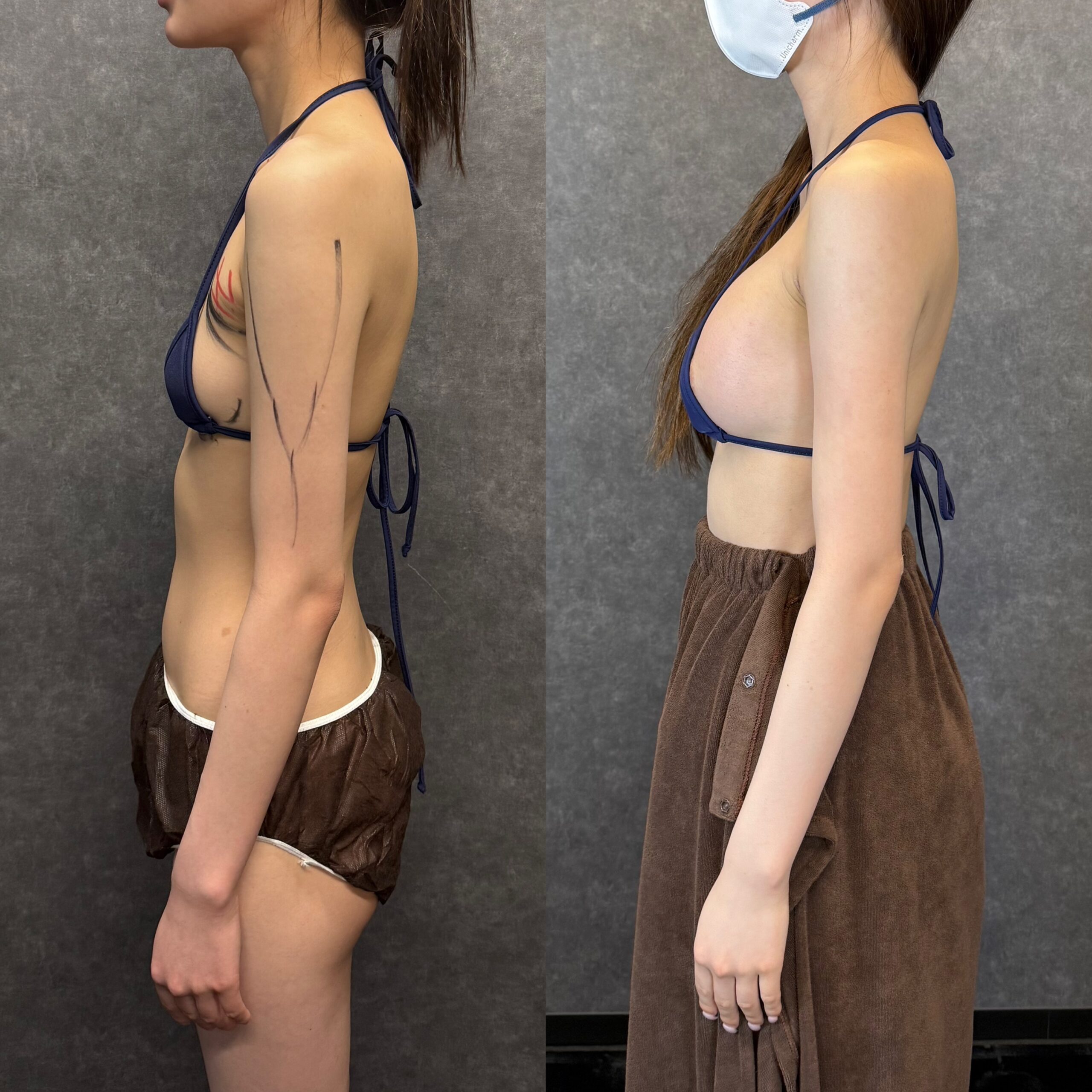 大腿后侧吸脂 香蕉卷 腘绳肌