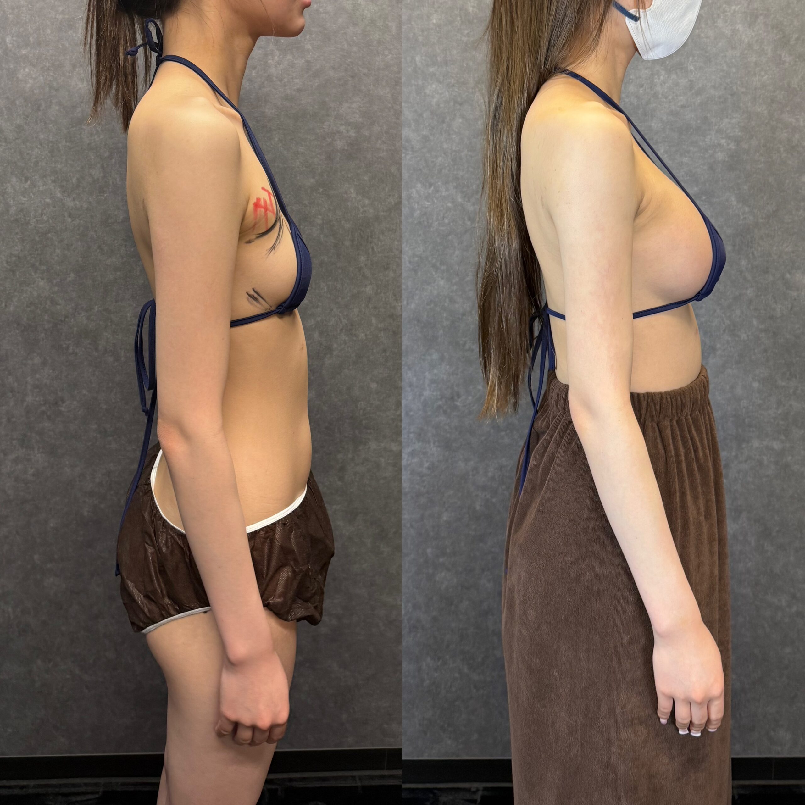 front thigh liposuction