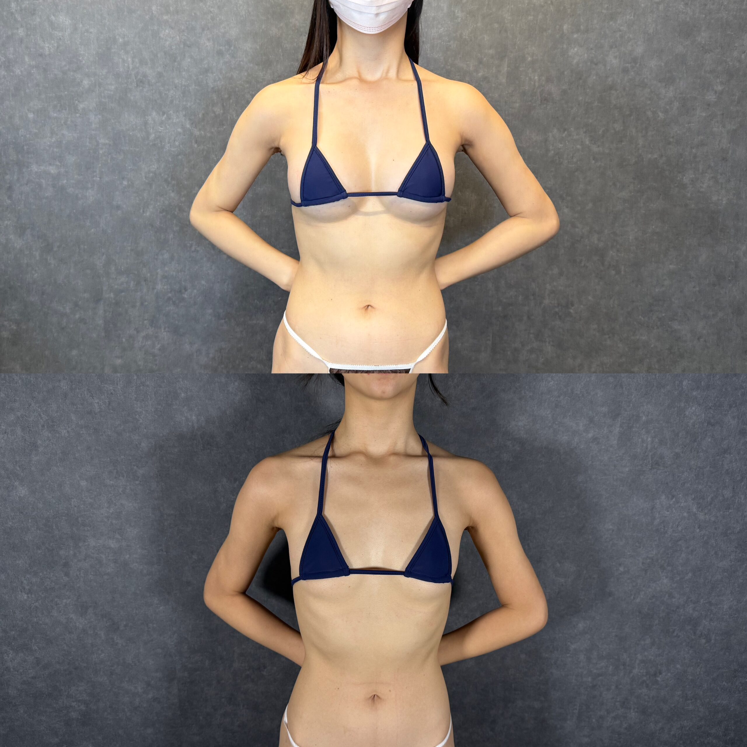 nâng ngực kết hợp phẫu thuật