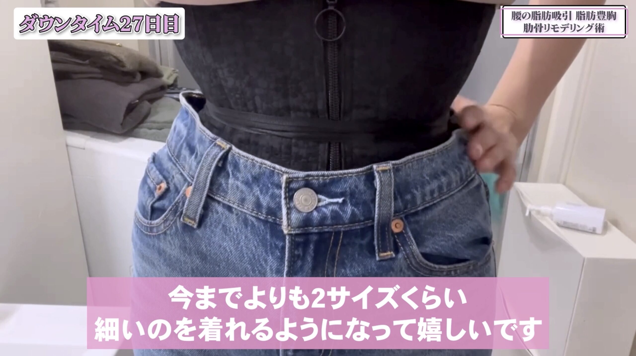 front thigh bulge fascia adhesion liposuction