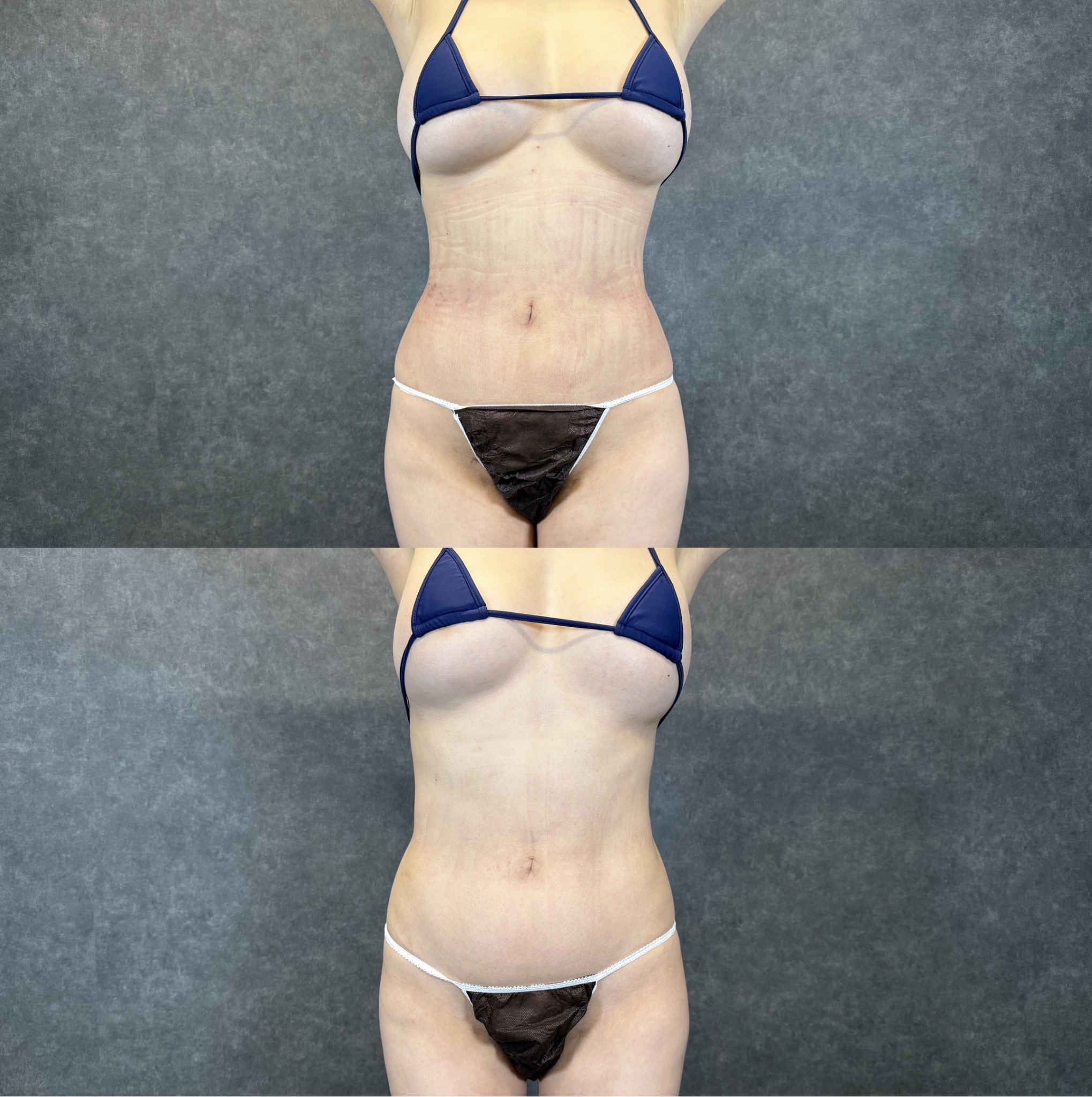 front thigh bulge liposuction fascia adhesion