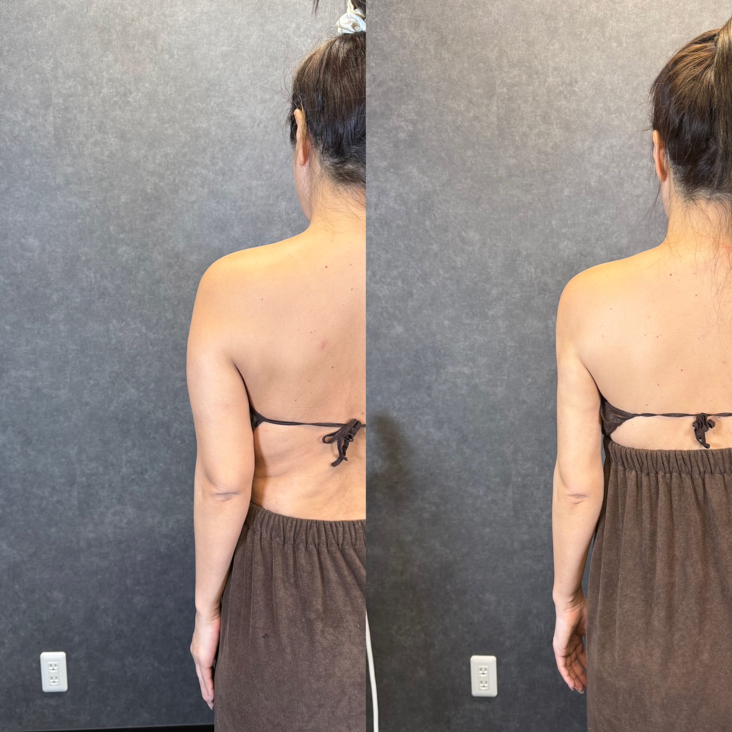 hybrid breast augmentation rib flare cleavage chest wall