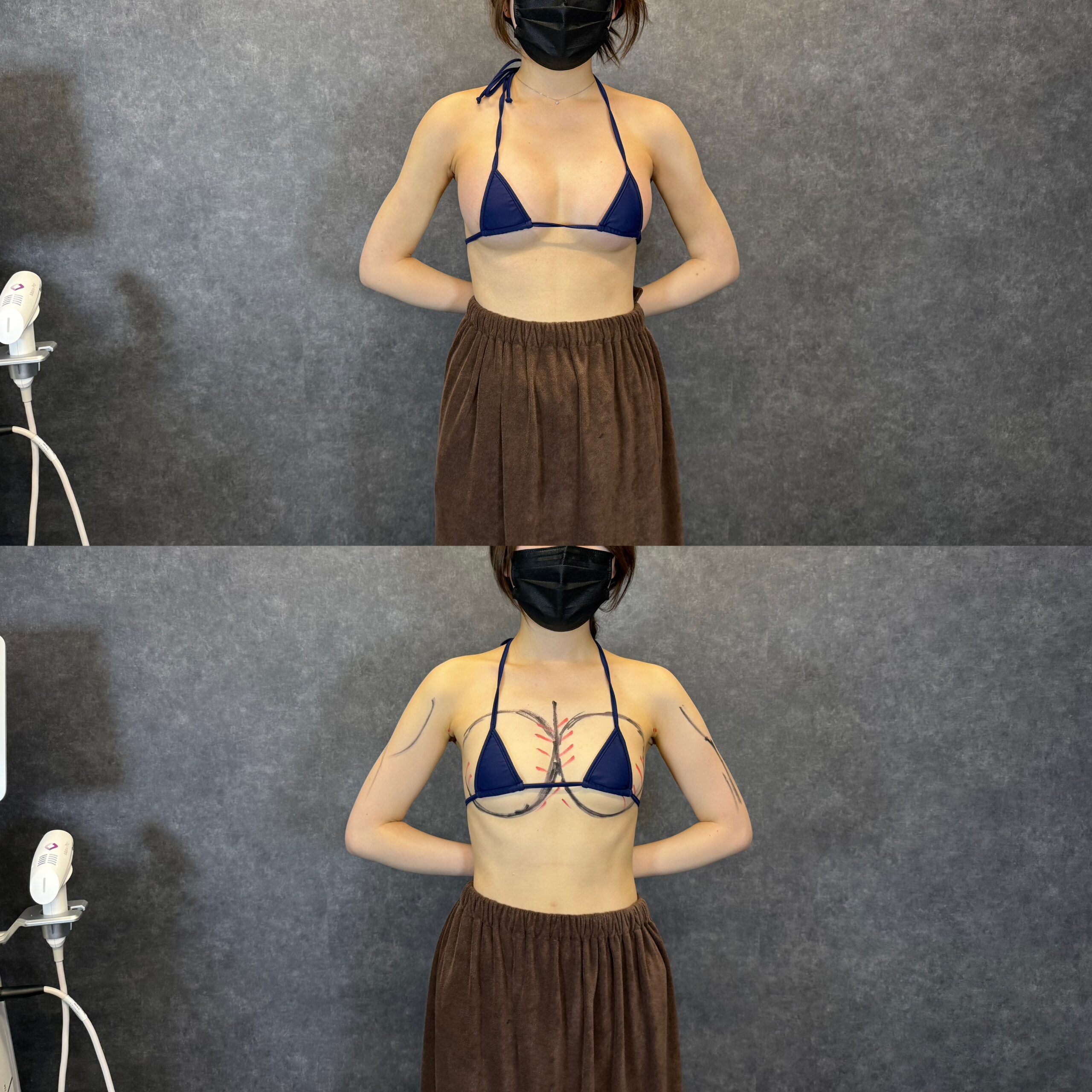 hút mỡ lặn biển bệnh giảm áp rủi ro