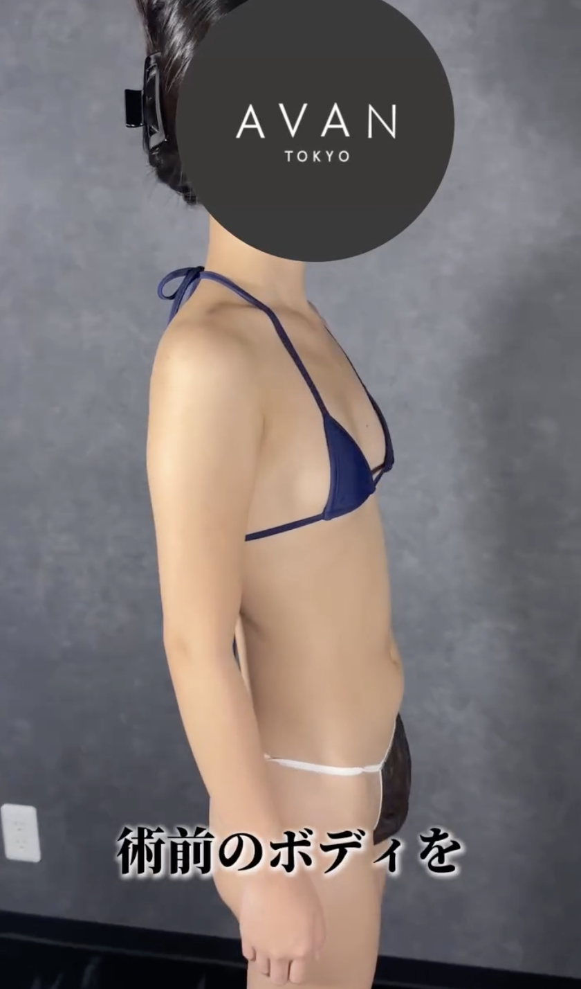 脂肪吸引 ガーメント かぶれ 接触皮膚炎 弾性着衣