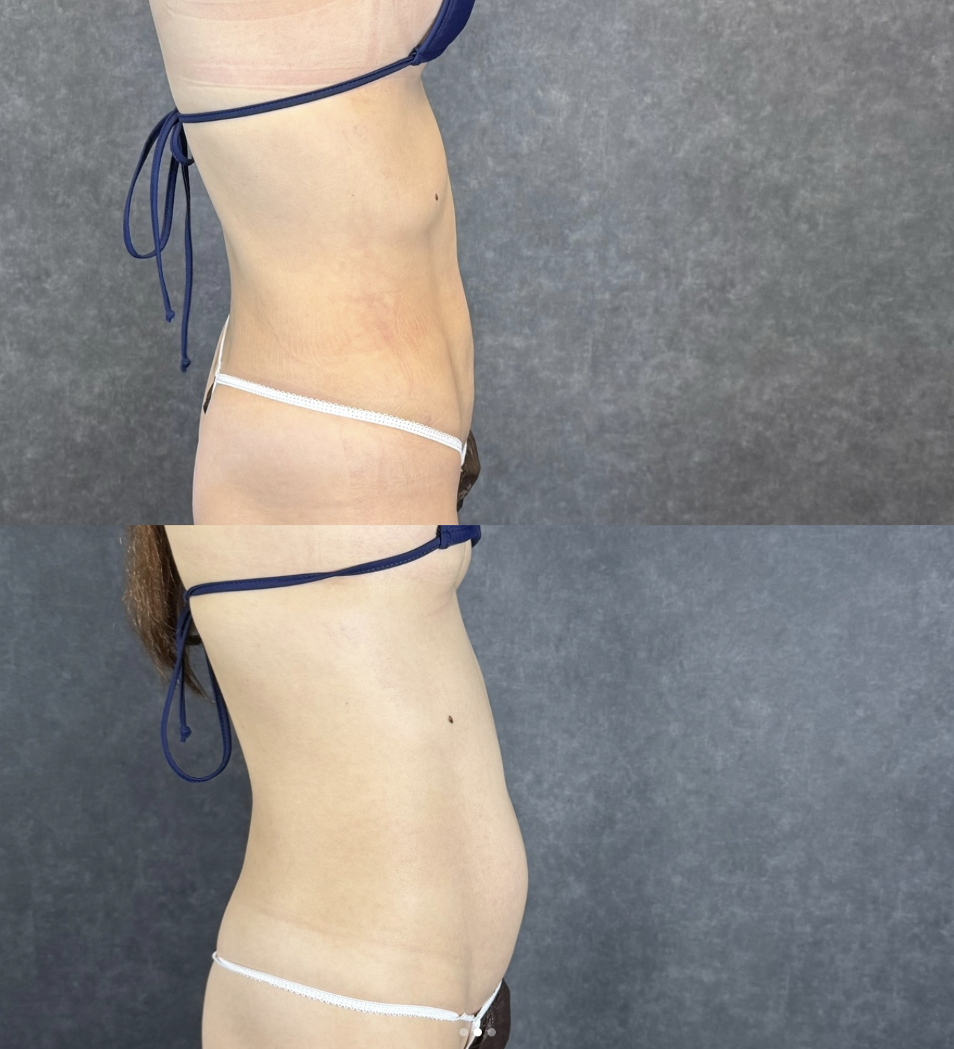 liposuction rebound body change before after