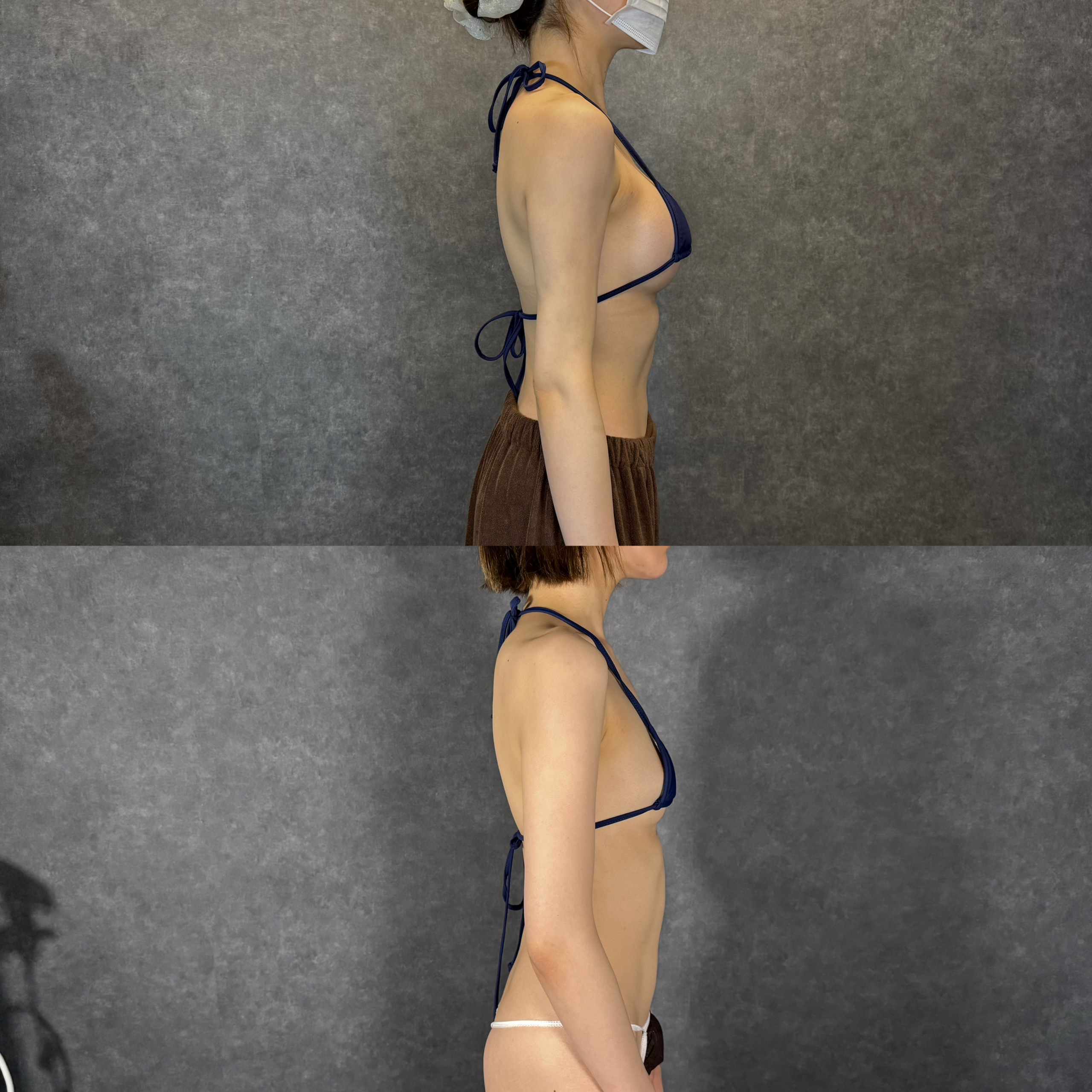 fat grafting breast augmentation mammography calcification