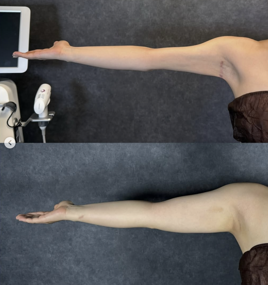liposuction unevenness