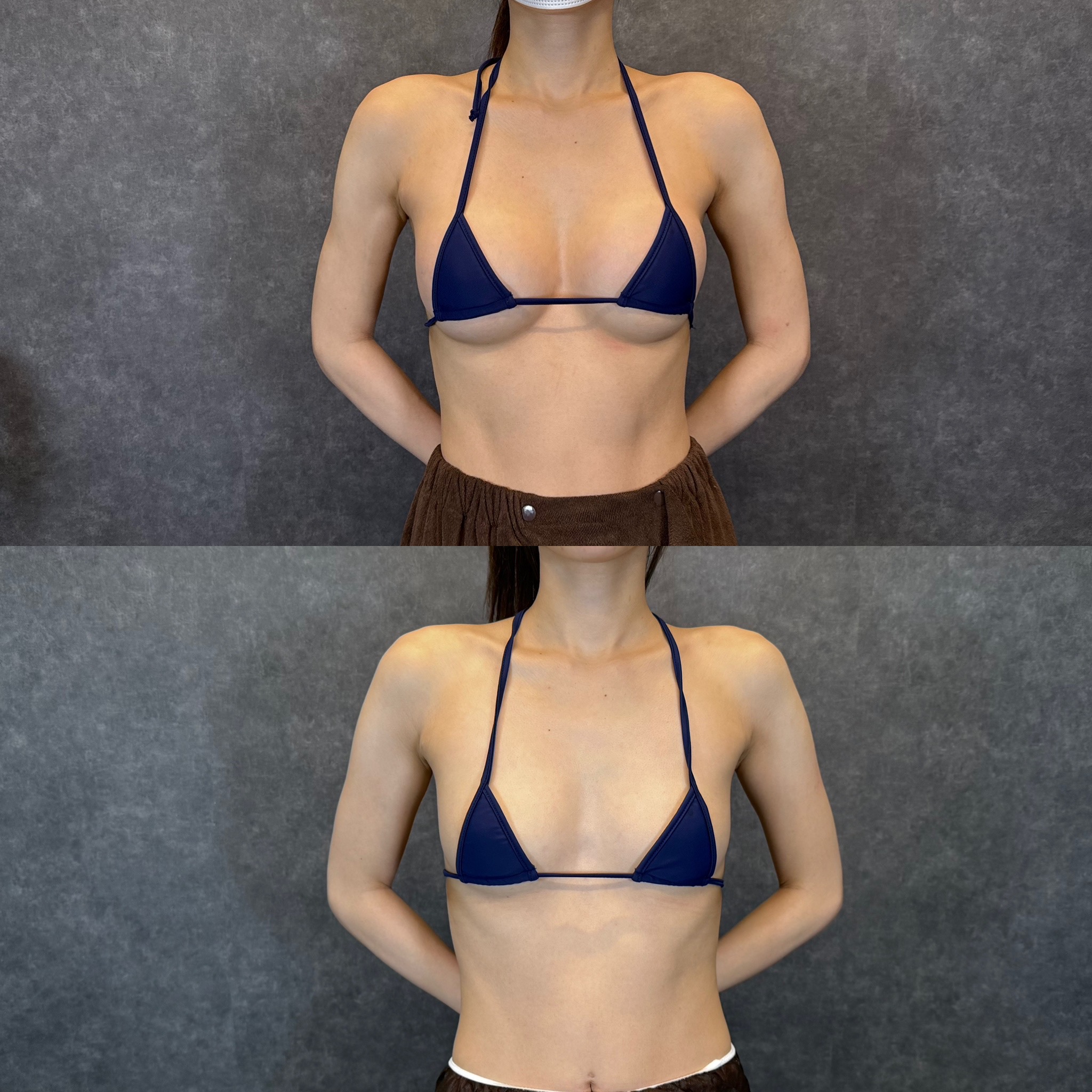 abdominal liposuction pain management