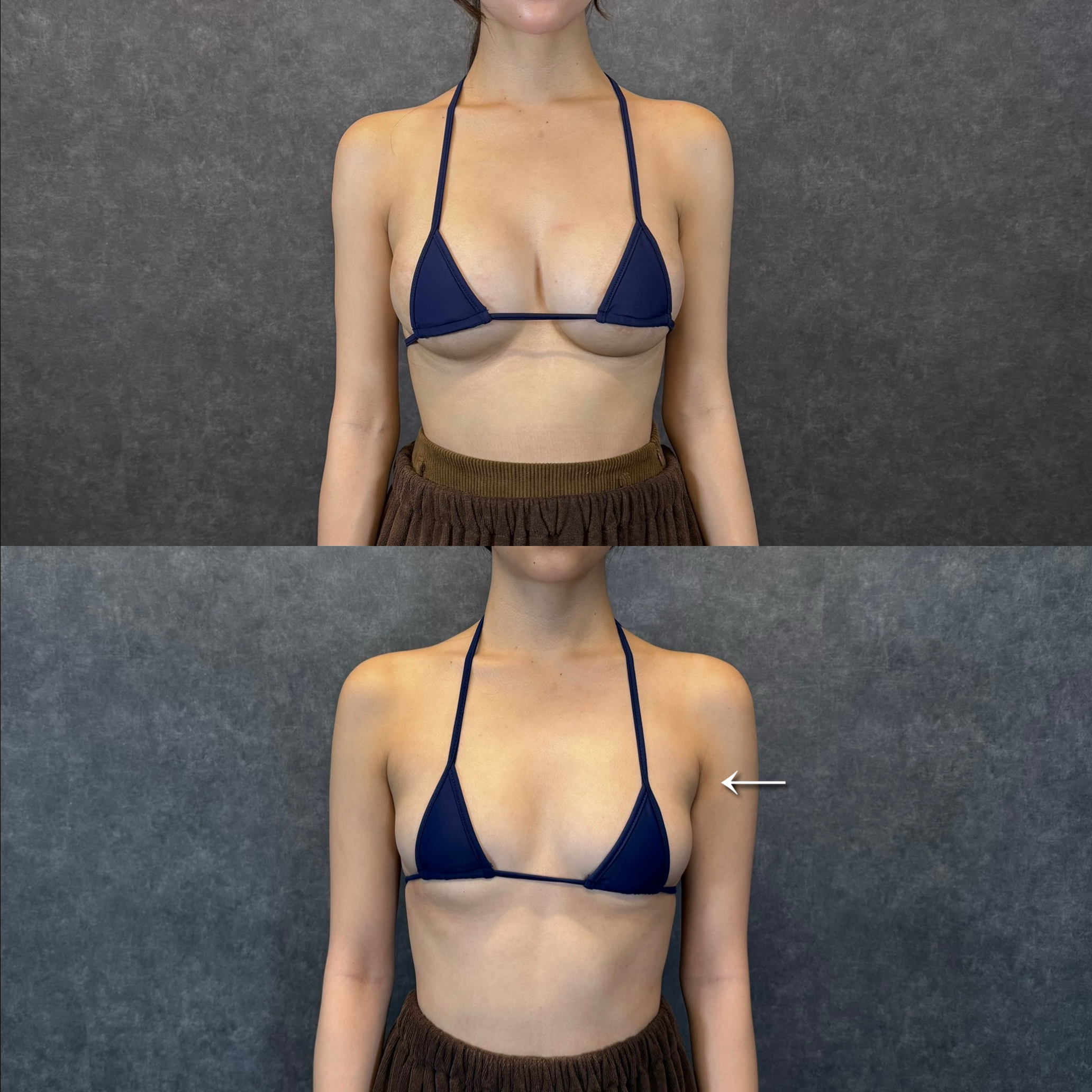 submental liposuction snoring sleep apnea