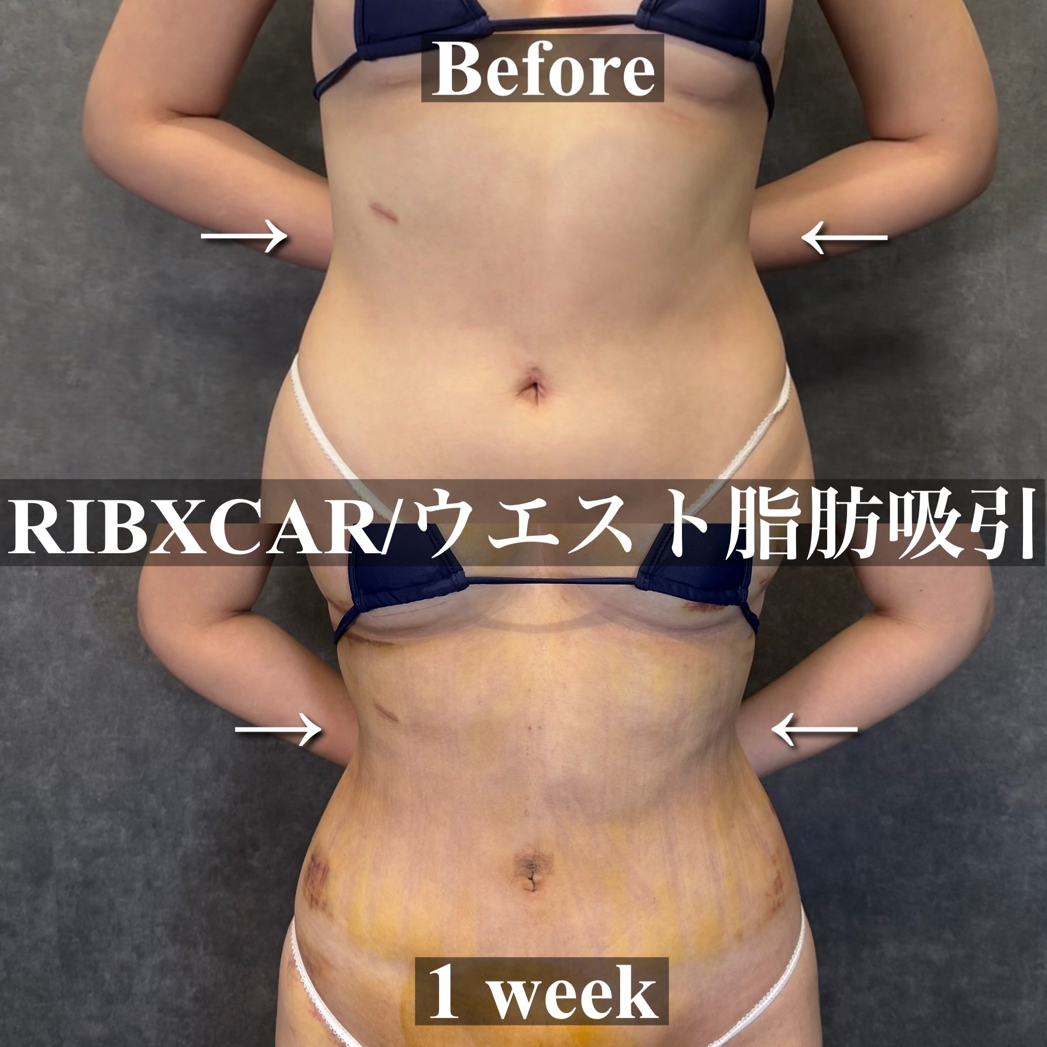 ウエスト脂肪吸引 Before/After 正面