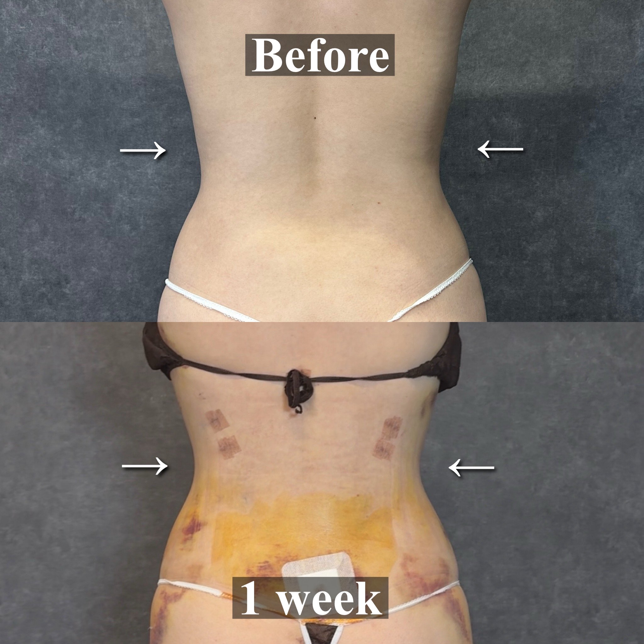 腹部脂肪吸引 Before/After 正面