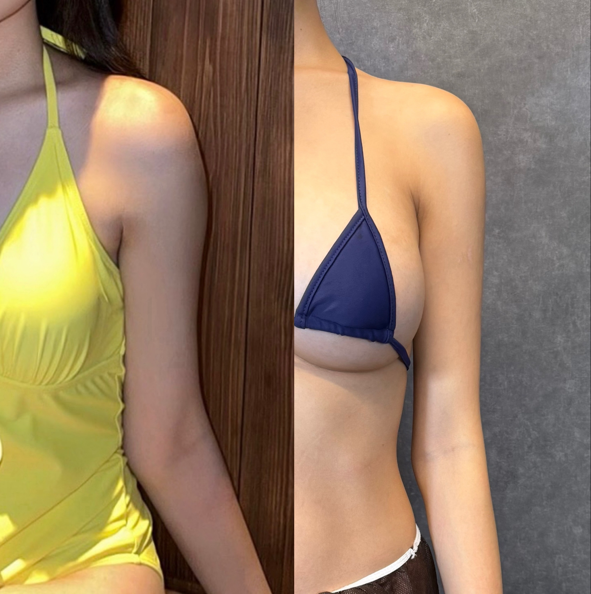 hút mỡ hỗ trợ năng lượng cơ học PAL VASER
