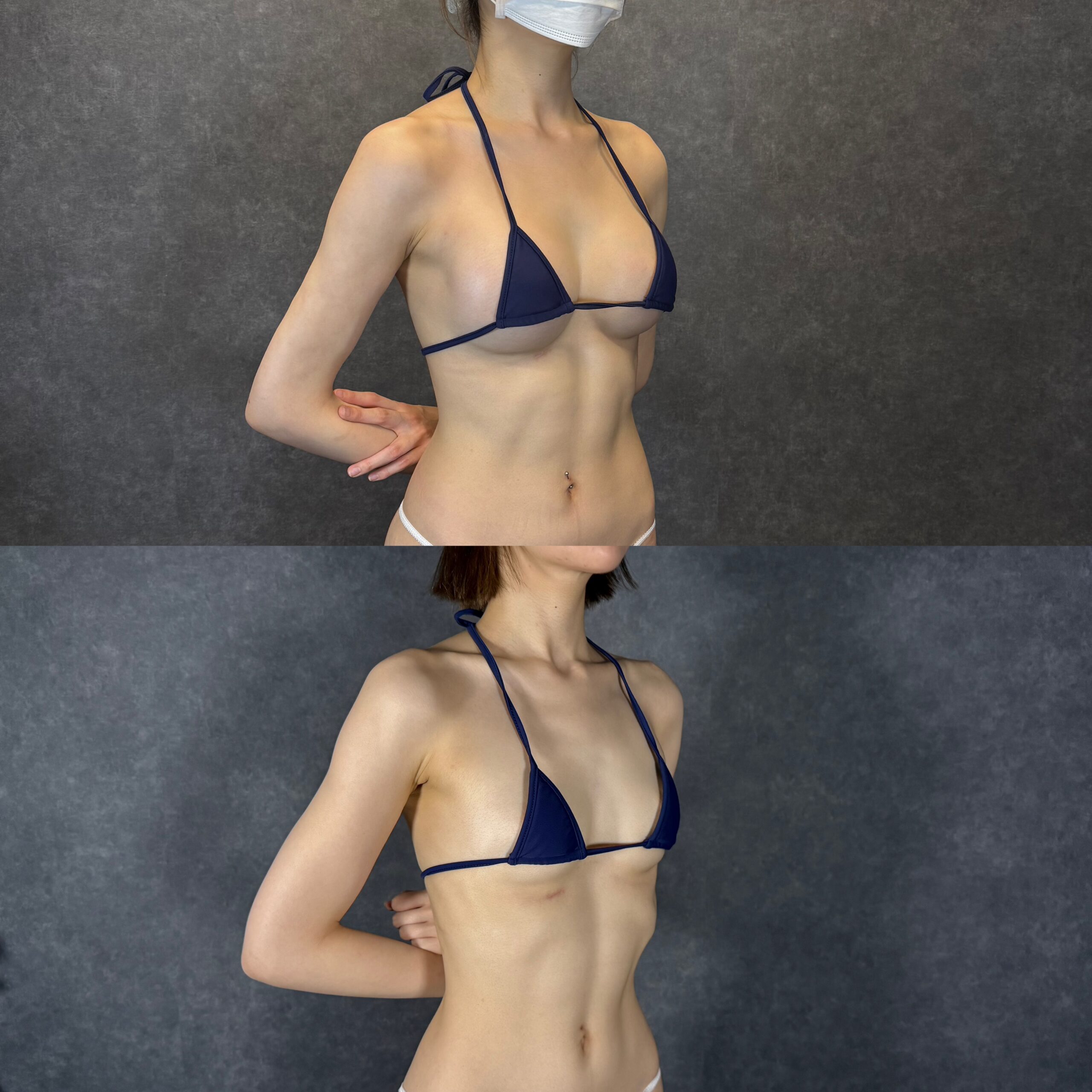 上半身脂肪吸引 Before/After 横