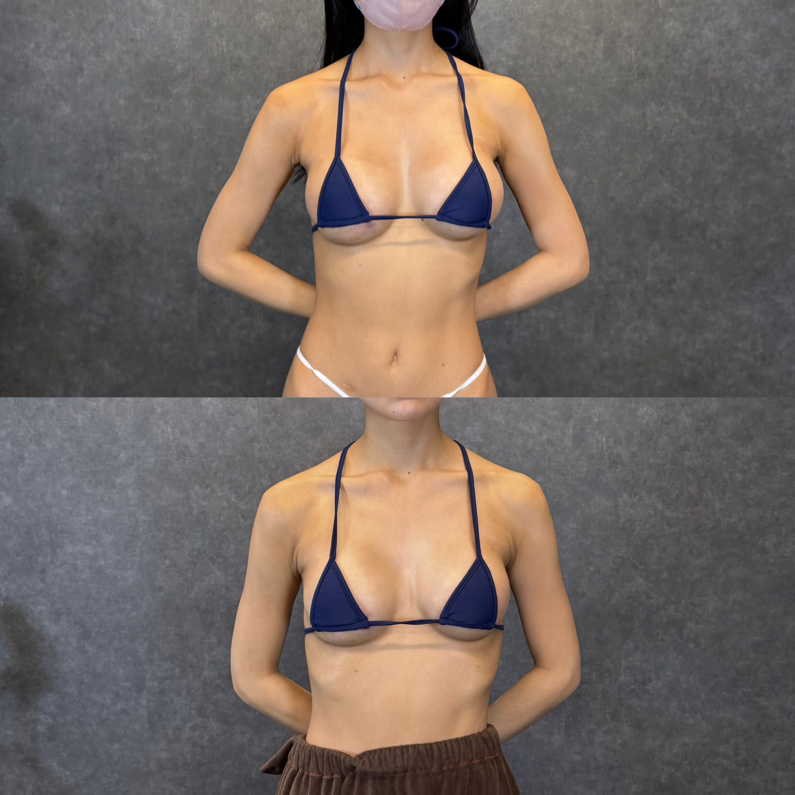 腰 脂肪吸引 ヒップアップ