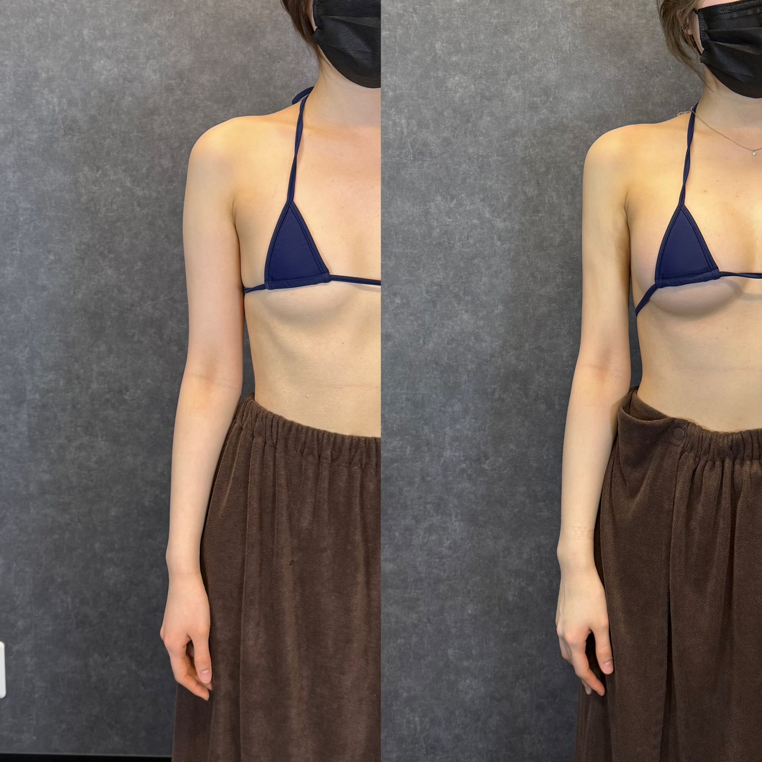 abdominal liposuction lower belly pocket
