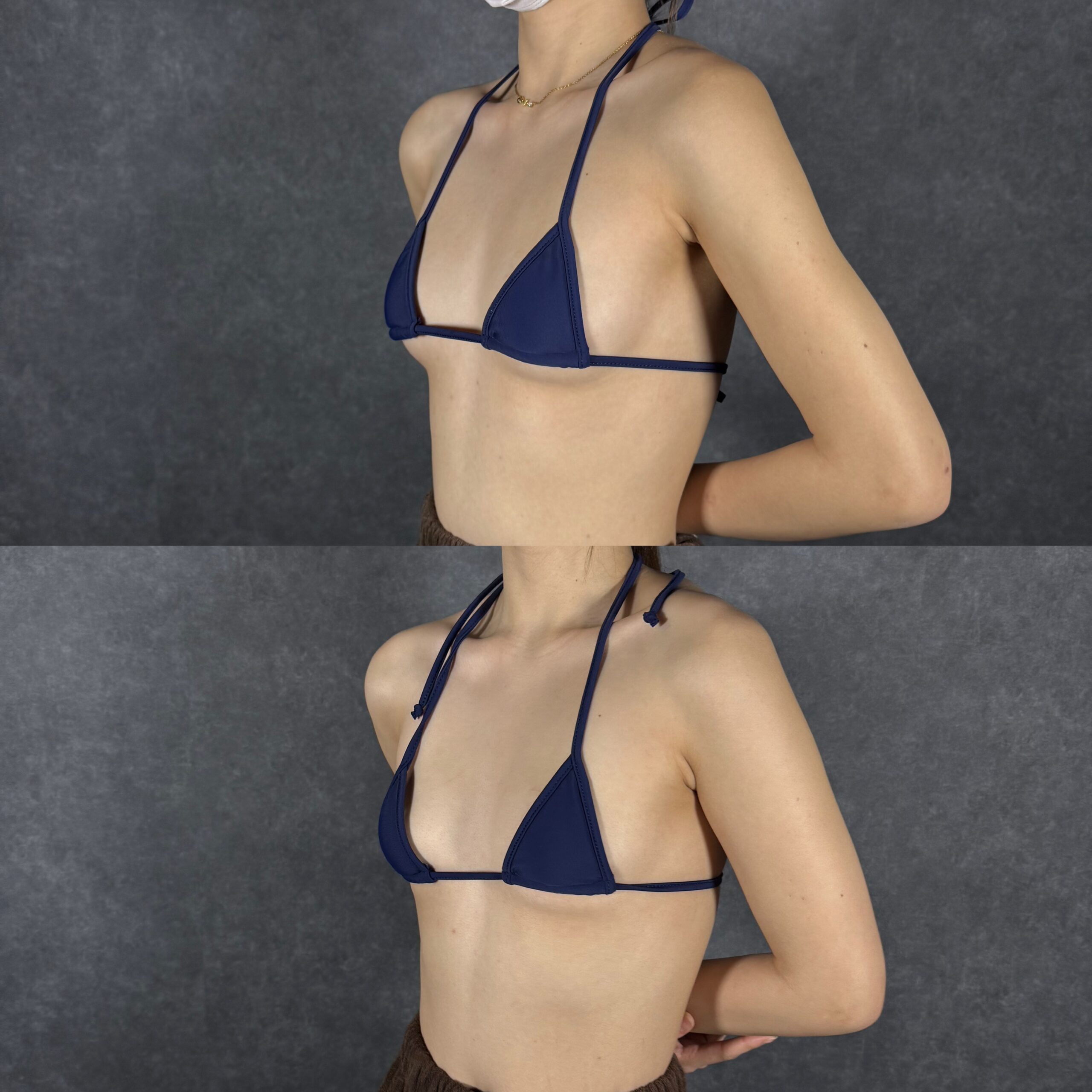 hút mỡ mons pubis vùng mu bụng dưới