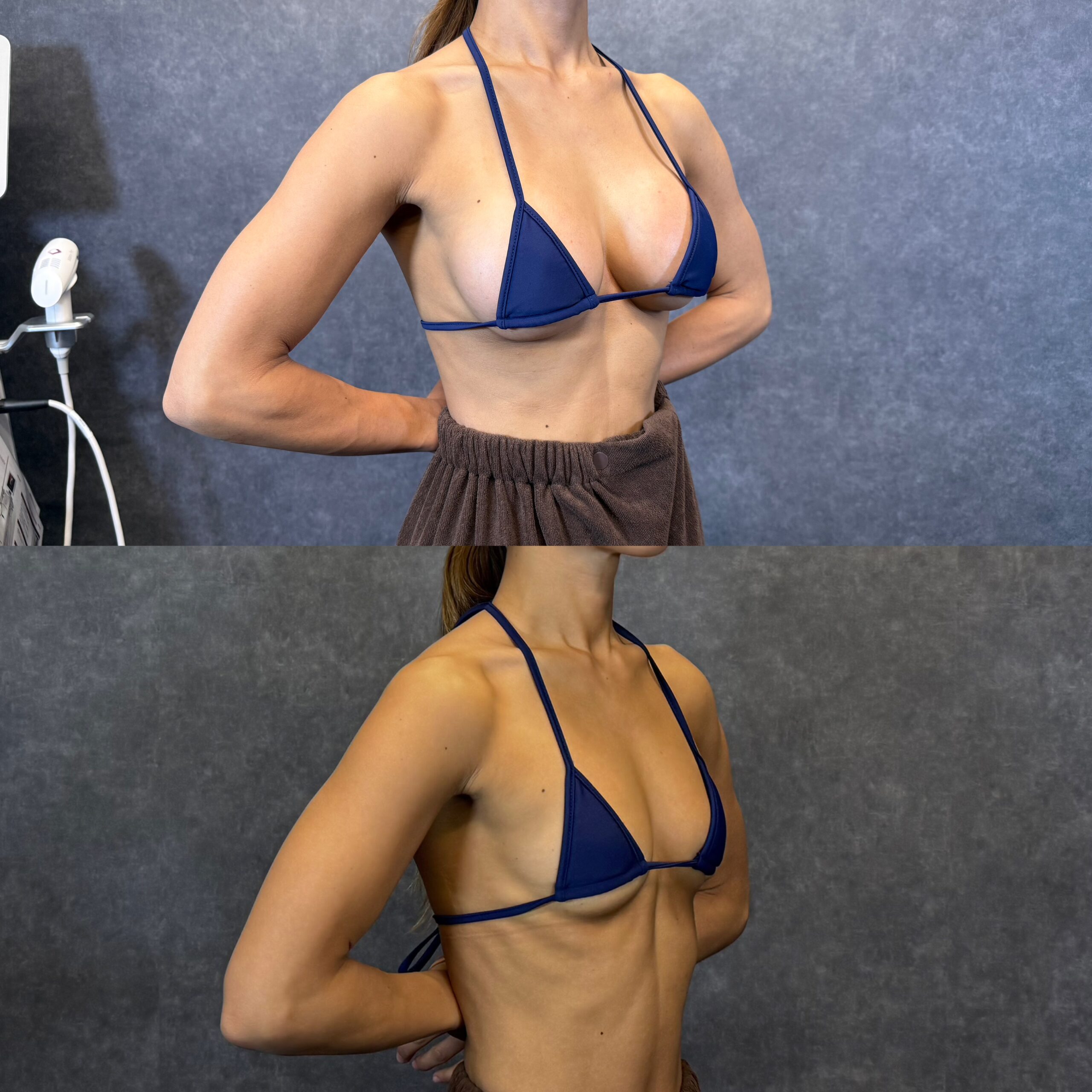 nâng ngực túi silicone