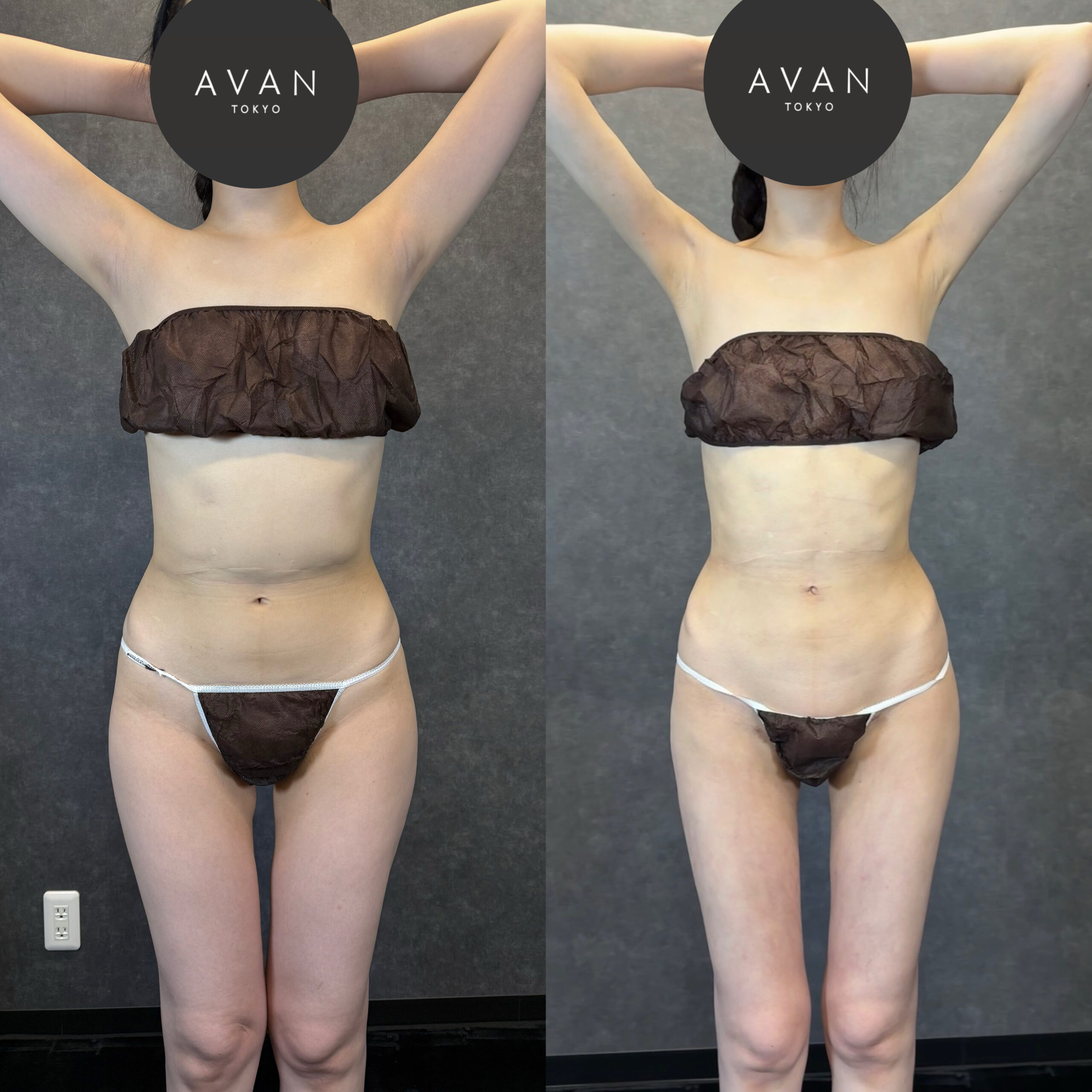 front thigh bulge fascia adhesion liposuction