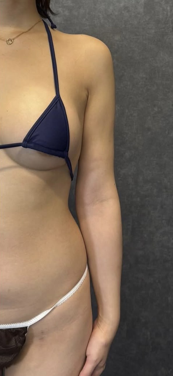 二の腕全周の脂肪吸引＋ハイブリッド豊胸 術後3ヶ月 20代女性症例