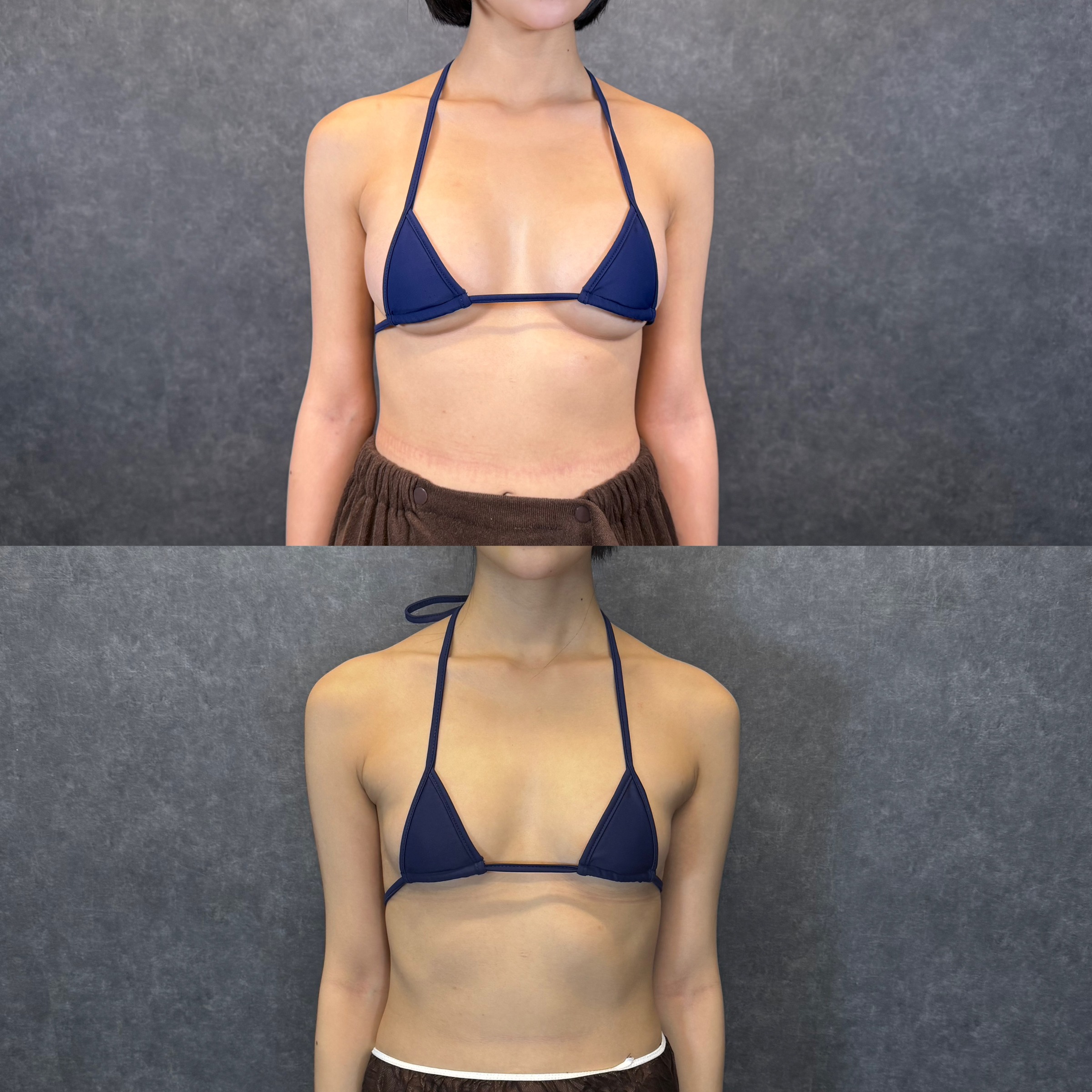ハイブリッド豊胸と二の腕全周・副乳の脂肪吸引 25歳女性 術後11ヶ月 ビフォーアフター（正面）