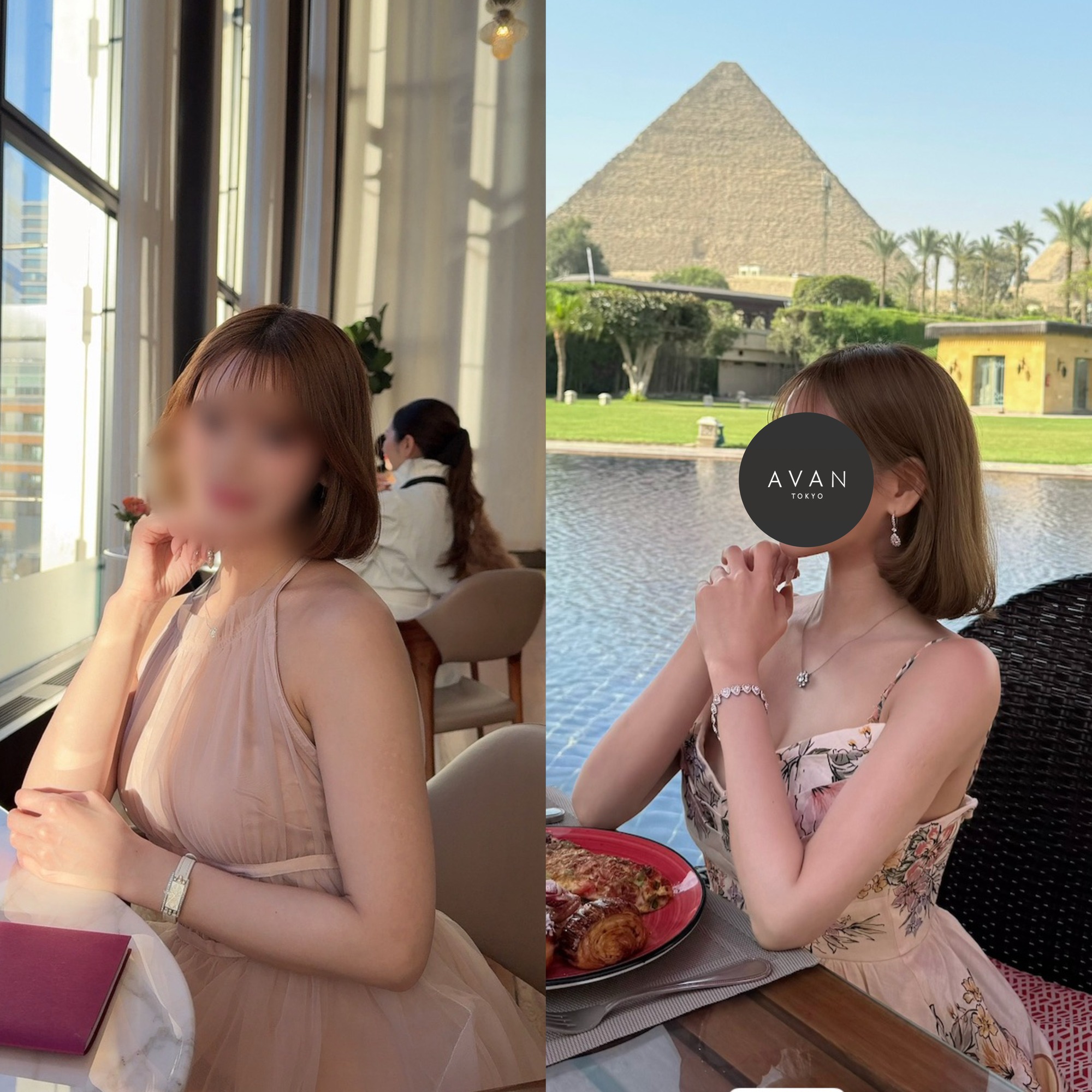 二の腕全周の脂肪吸引＋バイニードル｜26歳女性・術後6ヶ月