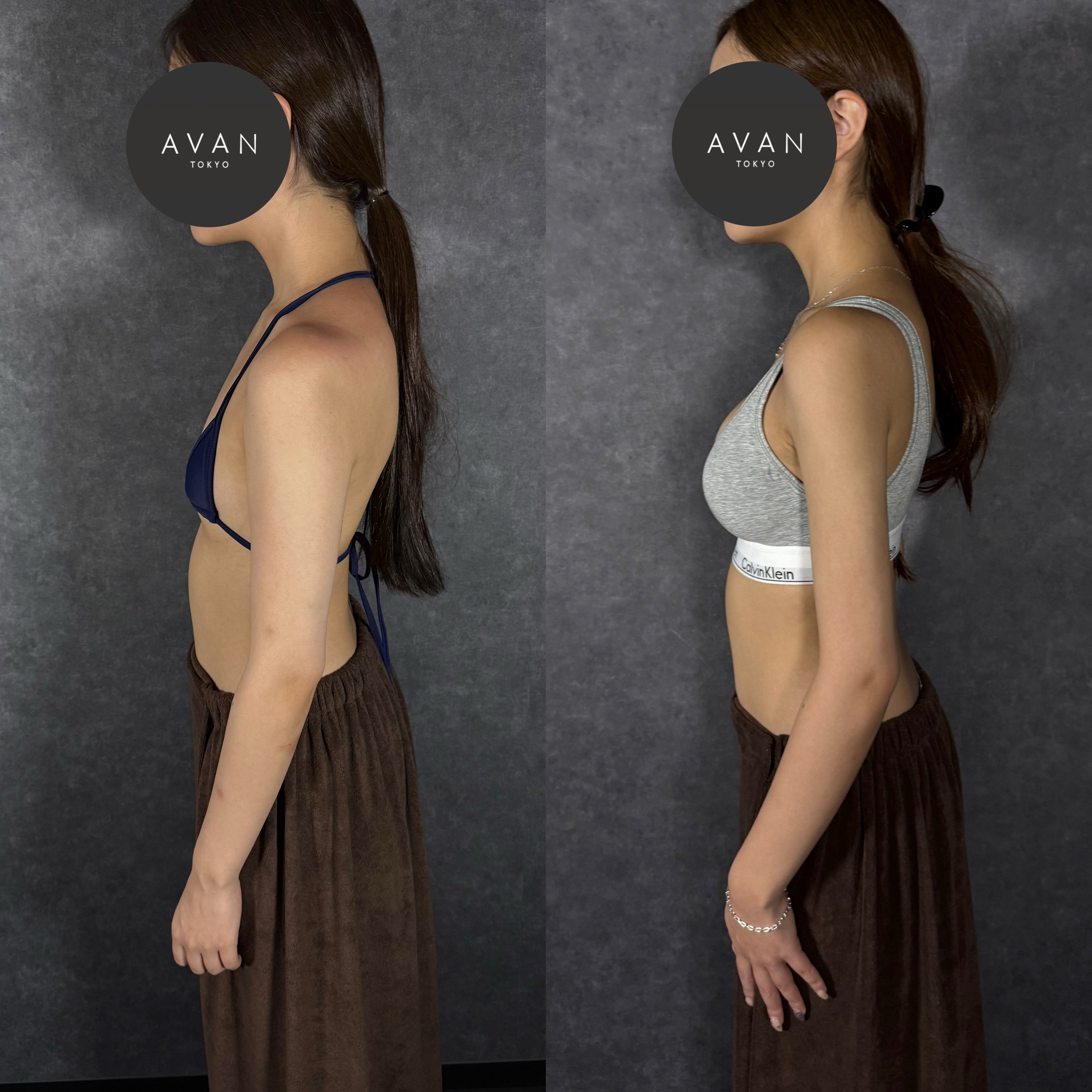 ハイブリッド豊胸（モティバミニ235cc）＋二の腕全周・副乳・脇肉の脂肪吸引 ビフォーアフター（側面） 24歳女性 術後6ヶ月