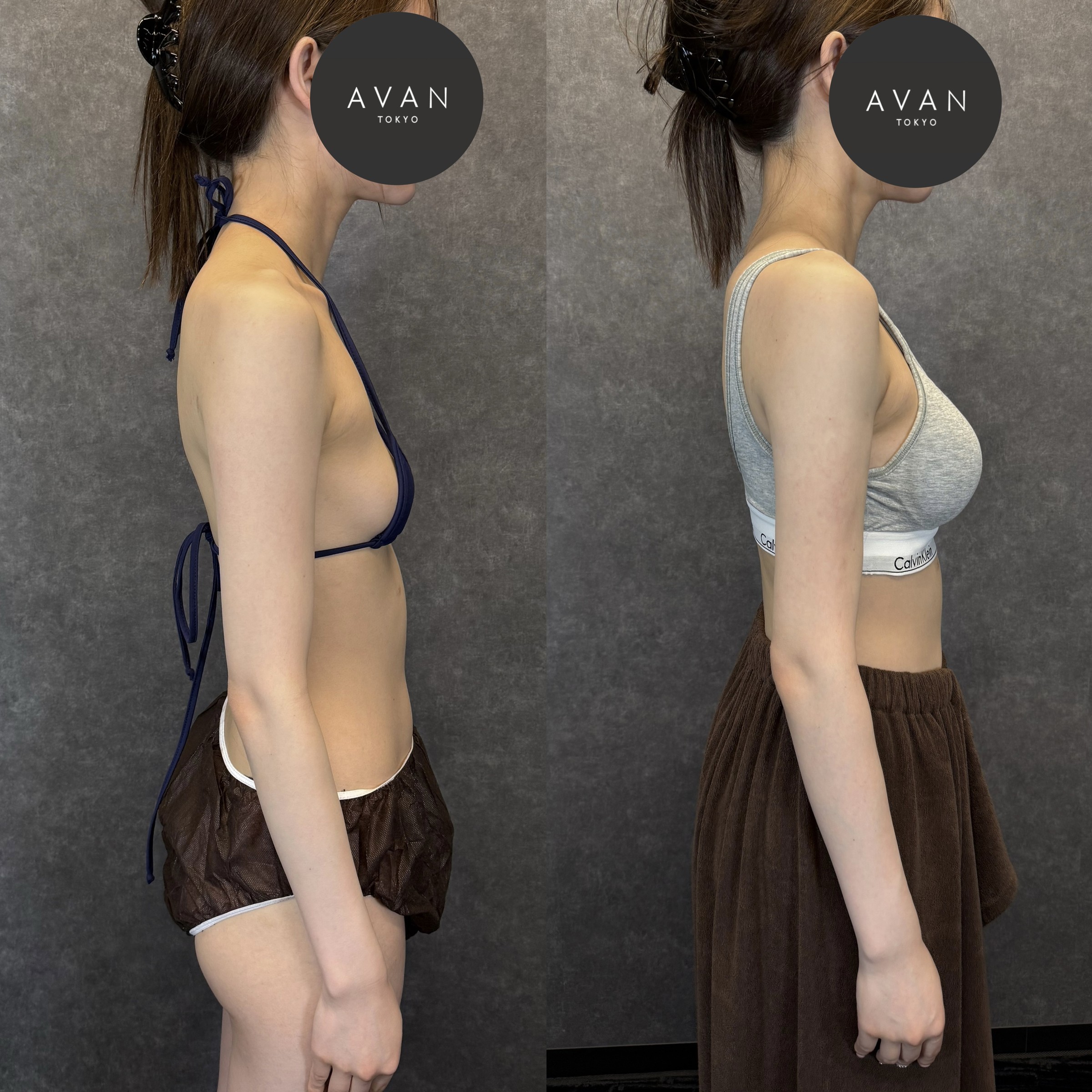 ハイブリッド豊胸（モティバミニ275cc）＋二の腕全周・副乳の脂肪吸引 ビフォーアフター（側面） 26歳女性 術後6ヶ月