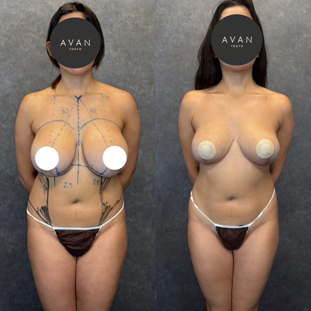 乳房縮小・吊り上げ＋シリコンバッグ入れ替え・側腹部脂肪吸引 ビフォーアフター（左：術前マーキング／右：術後2ヶ月） 26歳女性